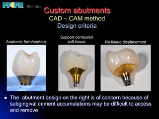 Custom abutments
CAD – CAM method
Design criteria
l  The abutment design on the right is of concern because of
subgingival cement accumulations may be difficult to access
and remove
Anatomic form/contour No tissue displacement
Support contoured
soft tissue
 