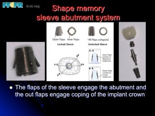 Shape memory
sleeve abutment system
l  The flaps of the sleeve engage the abutment and
the out flaps engage coping of the implant crown
 