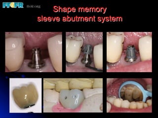 Shape memory
sleeve abutment system
 
