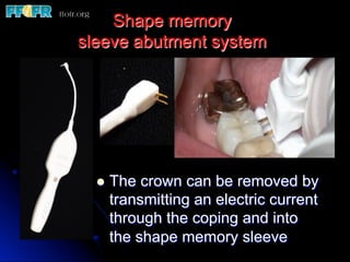 Shape memory
sleeve abutment system
l  The crown can be removed by
transmitting an electric current
through the coping and into
the shape memory sleeve
 