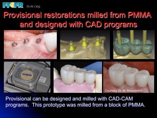 Provisional restorations milled from PMMA
and designed with CAD programs
Provisional can be designed and milled with CAD-CAM
programs. This prototype was milled from a block of PMMA.
Courtesy Dr. M. Moscovitch
 