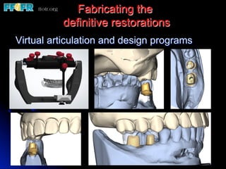 Fabricating the
definitive restorations
Virtual articulation and design programs
 