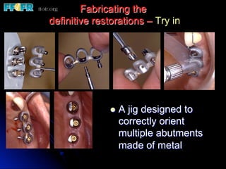 Fabricating the
definitive restorations – Try in
l  A jig designed to
correctly orient
multiple abutments
made of metal
 