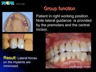 Group function
Patient in right working position.
Note lateral guidance is provided
by the premolars and the central
incisor.
Result: Lateral forces
on the implants are
minimized. Courtesy Dr. M. Hamada
 