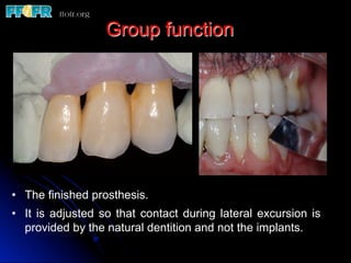 Group function
•  The finished prosthesis.
•  It is adjusted so that contact during lateral excursion is
provided by the natural dentition and not the implants.
 