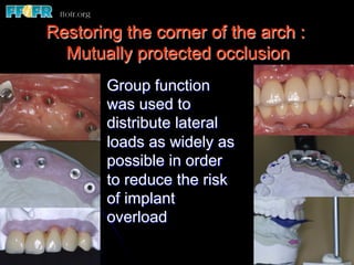 Restoring the corner of the arch :
Mutually protected occlusion
Group function
was used to
distribute lateral
loads as widely as
possible in order
to reduce the risk
of implant
overload
 