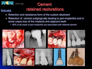 Cement
retained restorationsIssues
l  Retention and resistance form of the custom abutment
l  Retention of cement subgingivally leading to peri-implantitis and in
some cases loss of the implants and adjacent teeth
l  80% of all cases of peri-implantitis are associated with retained cement
 