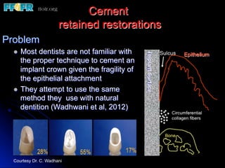 Cement
retained restorations
Problem
l  Most dentists are not familiar with
the proper technique to cement an
implant crown given the fragility of
the epithelial attachment
l  They attempt to use the same
method they use with natural
dentition (Wadhwani et al, 2012)
Courtesy Dr. C. Wadhani
 