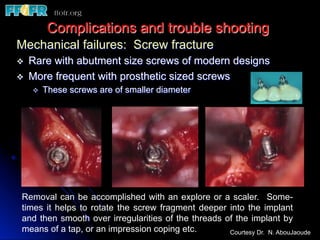Complications and trouble shooting
Mechanical failures: Screw fracture
v  Rare with abutment size screws of modern designs
v  More frequent with prosthetic sized screws
v  These screws are of smaller diameter
Removal can be accomplished with an explore or a scaler. Some-
times it helps to rotate the screw fragment deeper into the implant
and then smooth over irregularities of the threads of the implant by
means of a tap, or an impression coping etc. Courtesy Dr. N. AbouJaoude
 