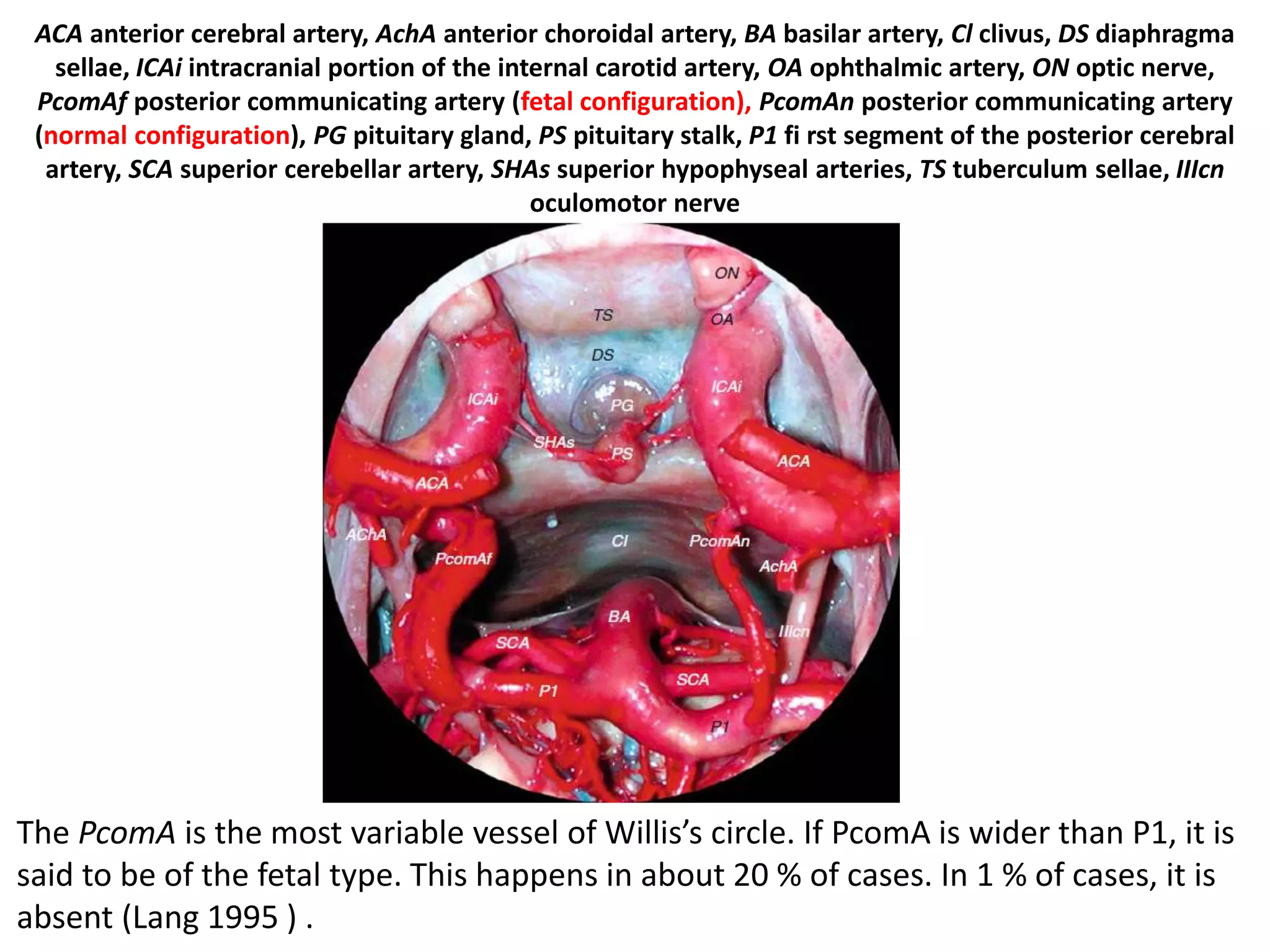 ACA anterior cerebral artery, AchA anterior choroidal artery, BA basilar artery, Cl clivus, DS diaphragma
sellae, ICAi intracranial portion of the internal carotid artery, OA ophthalmic artery, ON optic nerve,
PcomAf posterior communicating artery (fetal configuration), PcomAn posterior communicating artery
(normal configuration), PG pituitary gland, PS pituitary stalk, P1 fi rst segment of the posterior cerebral
artery, SCA superior cerebellar artery, SHAs superior hypophyseal arteries, TS tuberculum sellae, IIIcn
oculomotor nerve
The PcomA is the most variable vessel of Willis’s circle. If PcomA is wider than P1, it is
said to be of the fetal type. This happens in about 20 % of cases. In 1 % of cases, it is
absent (Lang 1995 ) .
 