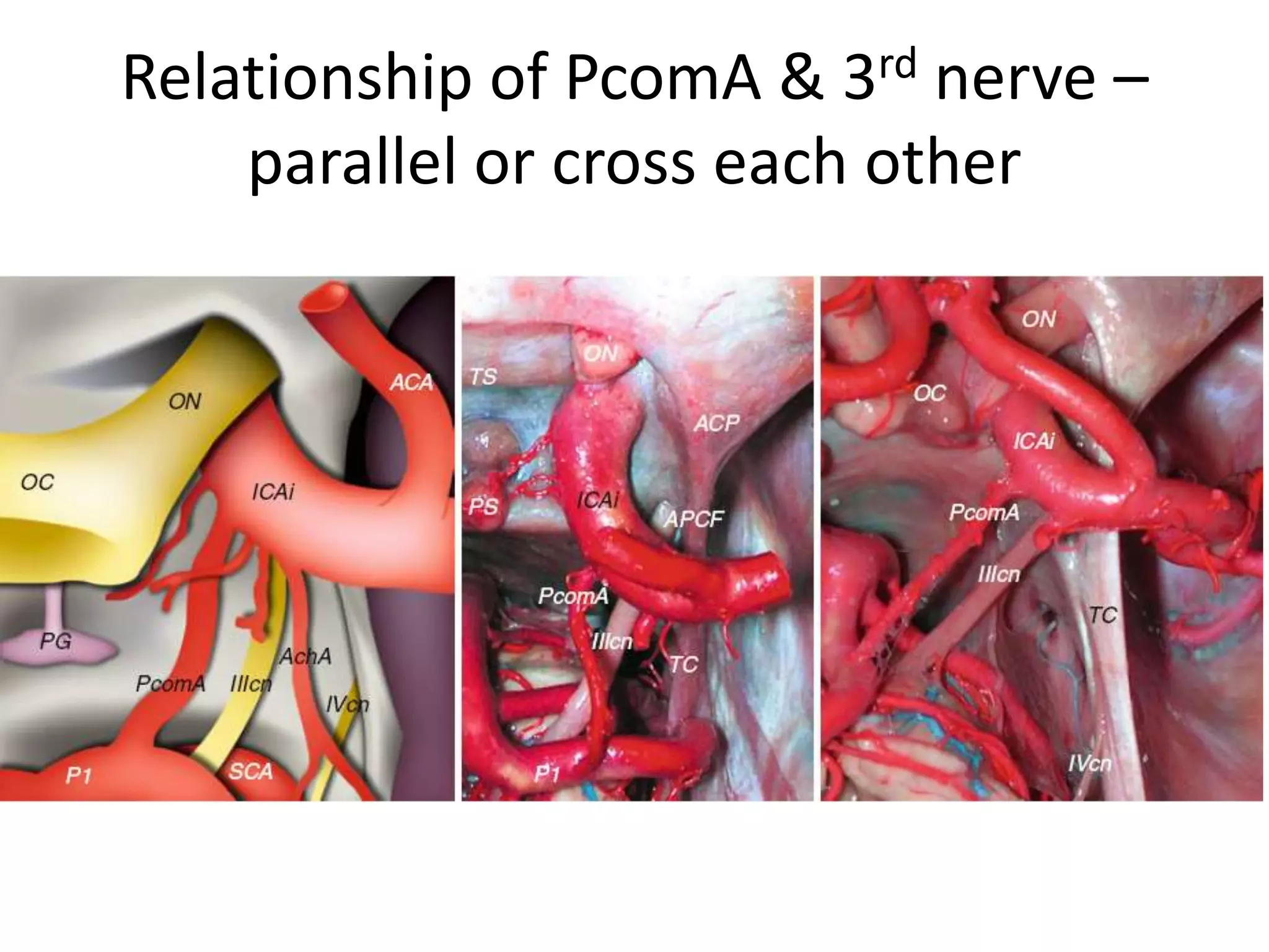 Relationship of PcomA & 3rd nerve –
parallel or cross each other
 