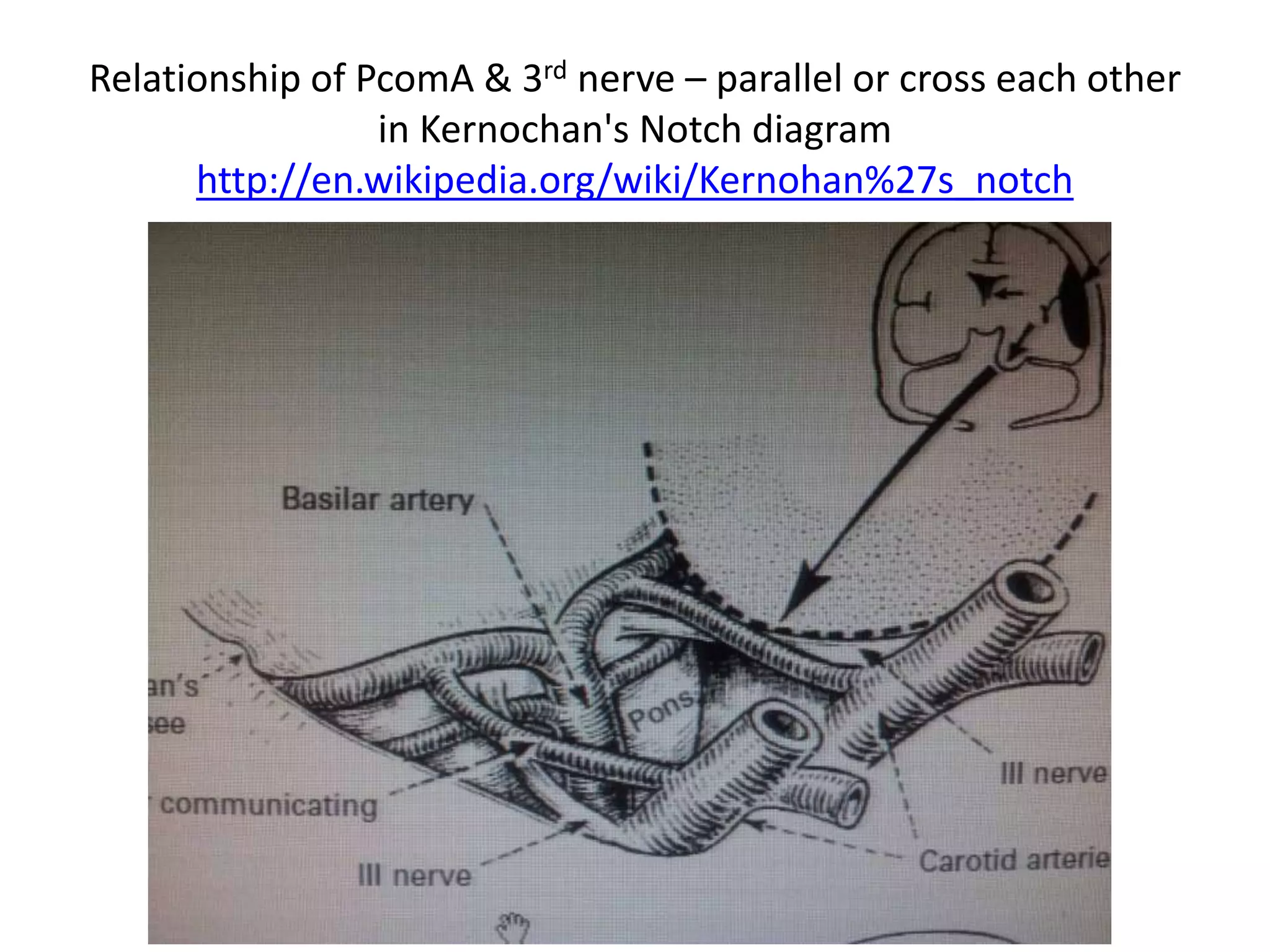 Relationship of PcomA & 3rd nerve – parallel or cross each other
in Kernochan's Notch diagram
http://en.wikipedia.org/wiki/Kernohan%27s_notch
 