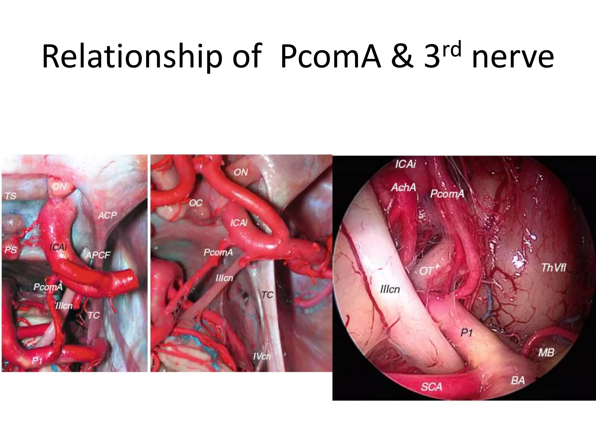 Relationship of PcomA & 3rd nerve
 