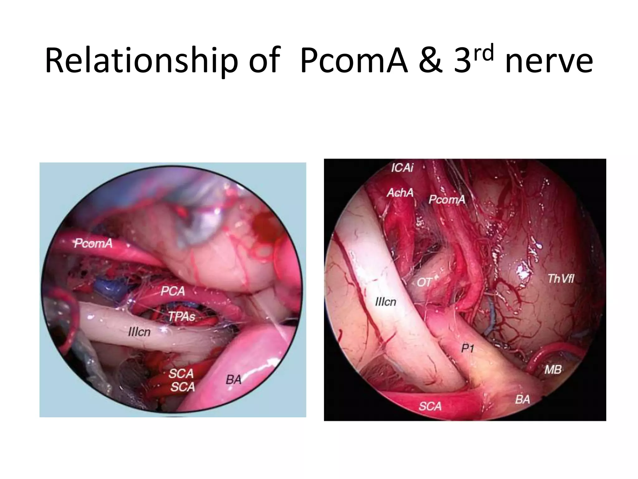 Relationship of PcomA & 3rd nerve
 