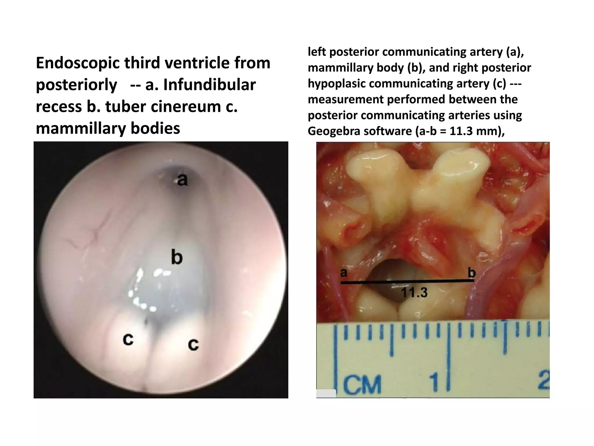 Endoscopic third ventricle from
posteriorly -- a. Infundibular
recess b. tuber cinereum c.
mammillary bodies
left posterior communicating artery (a),
mammillary body (b), and right posterior
hypoplasic communicating artery (c) ---
measurement performed between the
posterior communicating arteries using
Geogebra software (a-b = 11.3 mm),
 