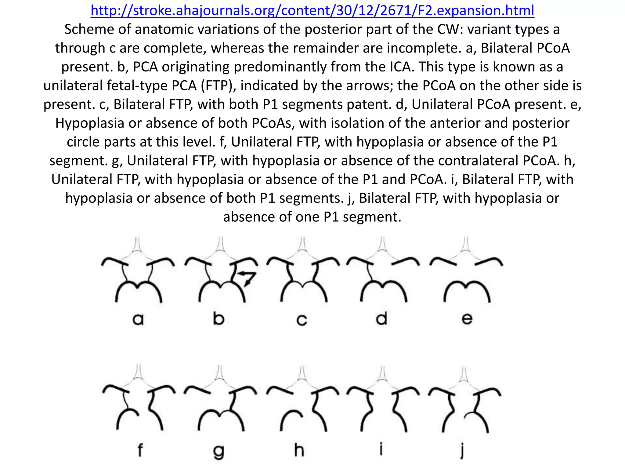 http://stroke.ahajournals.org/content/30/12/2671/F2.expansion.html
Scheme of anatomic variations of the posterior part of the CW: variant types a
through c are complete, whereas the remainder are incomplete. a, Bilateral PCoA
present. b, PCA originating predominantly from the ICA. This type is known as a
unilateral fetal-type PCA (FTP), indicated by the arrows; the PCoA on the other side is
present. c, Bilateral FTP, with both P1 segments patent. d, Unilateral PCoA present. e,
Hypoplasia or absence of both PCoAs, with isolation of the anterior and posterior
circle parts at this level. f, Unilateral FTP, with hypoplasia or absence of the P1
segment. g, Unilateral FTP, with hypoplasia or absence of the contralateral PCoA. h,
Unilateral FTP, with hypoplasia or absence of the P1 and PCoA. i, Bilateral FTP, with
hypoplasia or absence of both P1 segments. j, Bilateral FTP, with hypoplasia or
absence of one P1 segment.
 