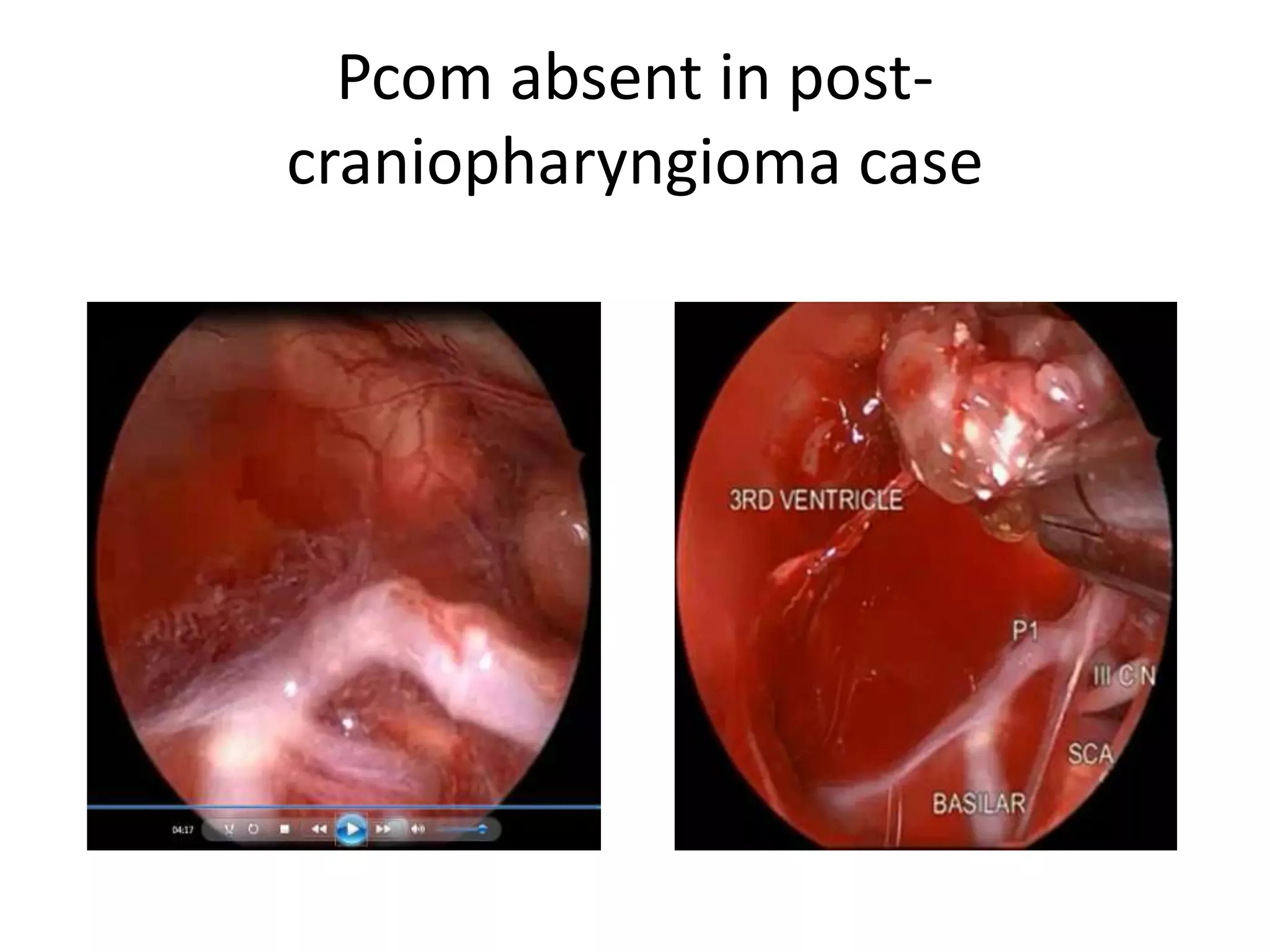 Pcom absent in post-
craniopharyngioma case
 
