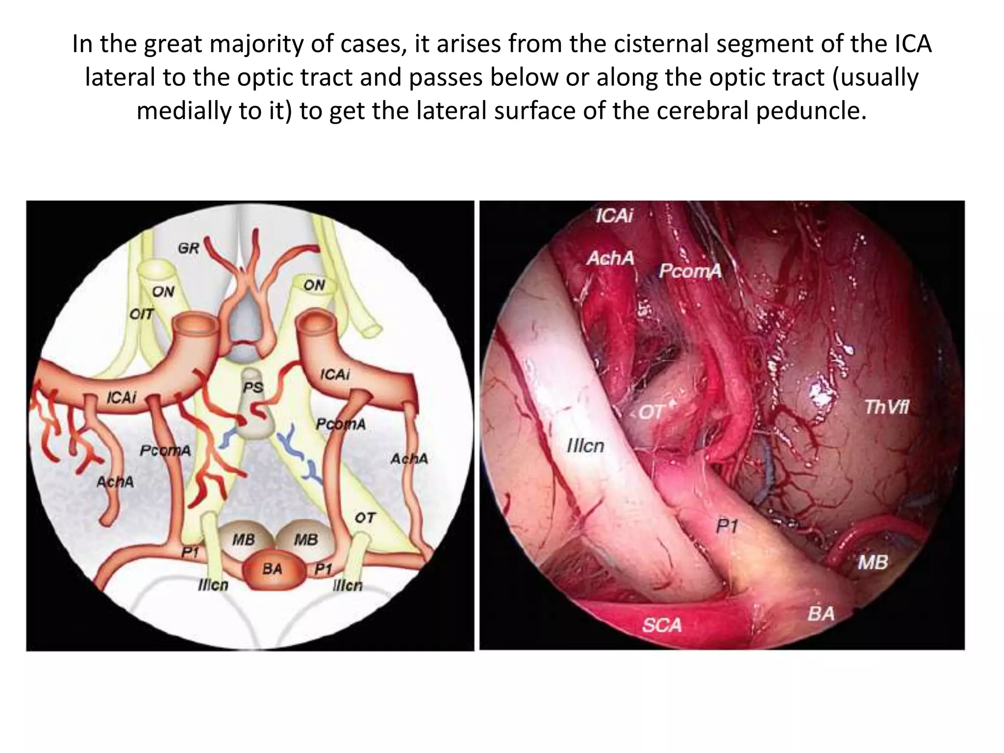 In the great majority of cases, it arises from the cisternal segment of the ICA
lateral to the optic tract and passes below or along the optic tract (usually
medially to it) to get the lateral surface of the cerebral peduncle.
 