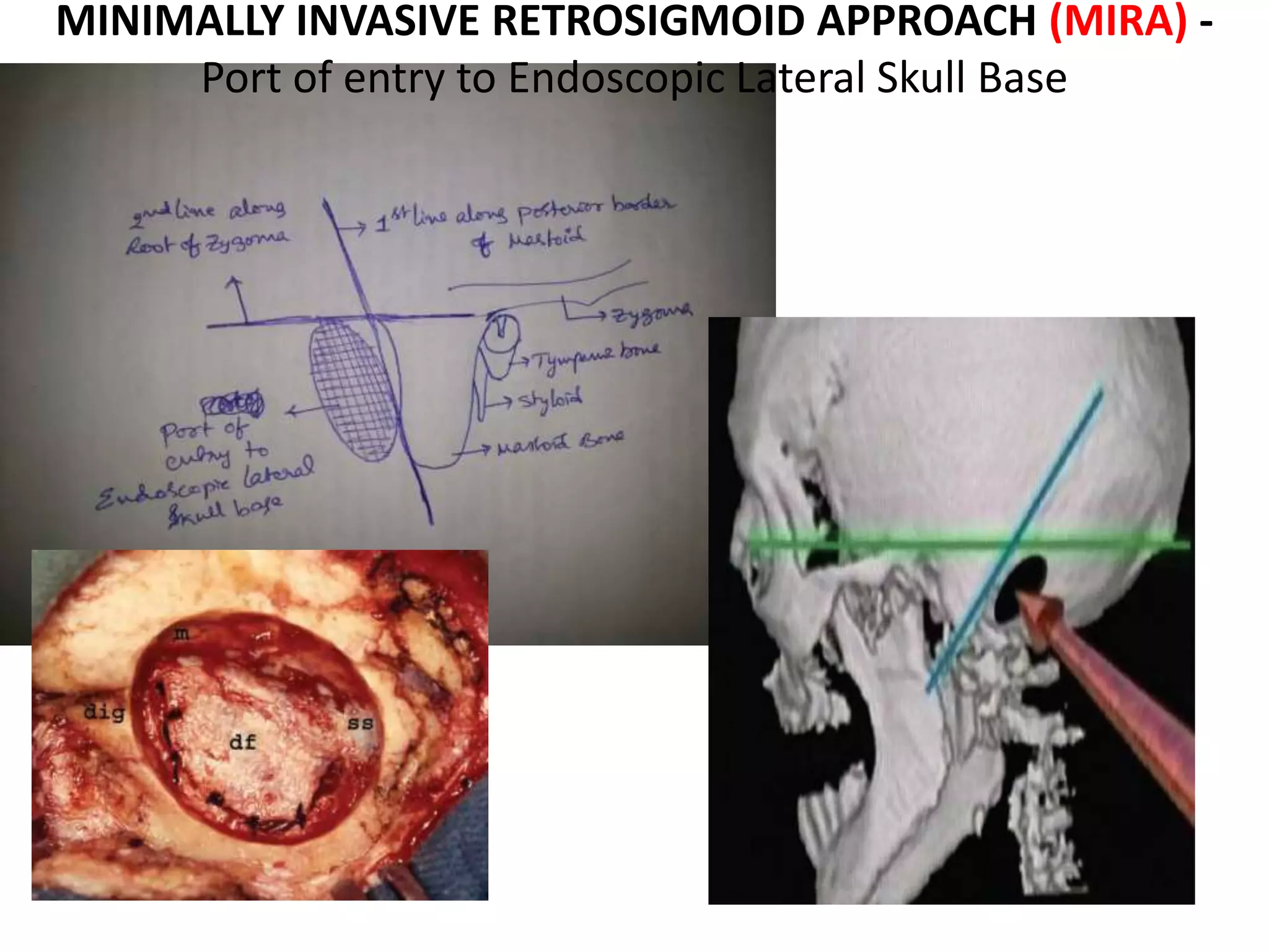 MINIMALLY INVASIVE RETROSIGMOID APPROACH (MIRA) -
Port of entry to Endoscopic Lateral Skull Base
 