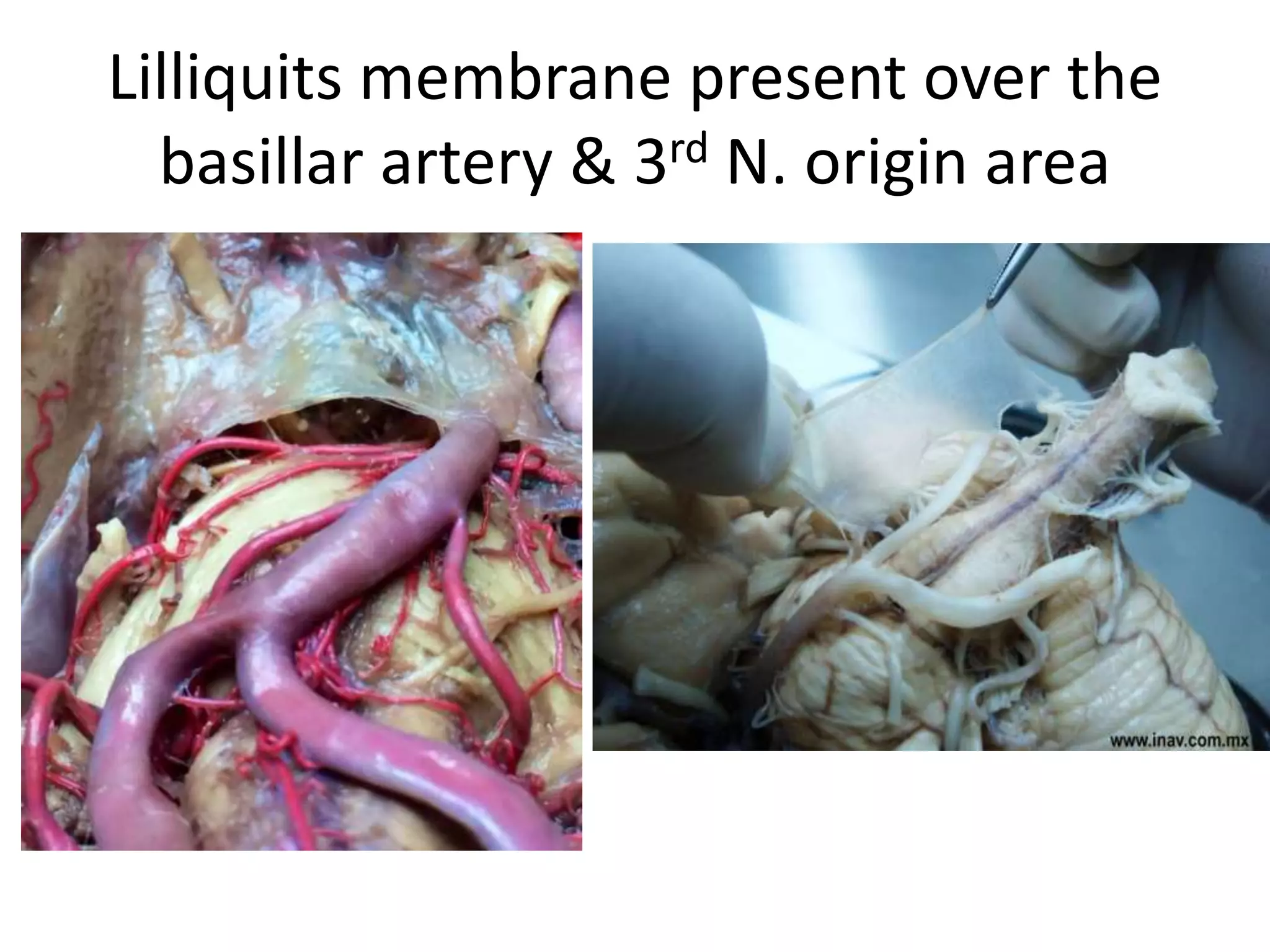 Lilliquits membrane present over the
basillar artery & 3rd N. origin area
 