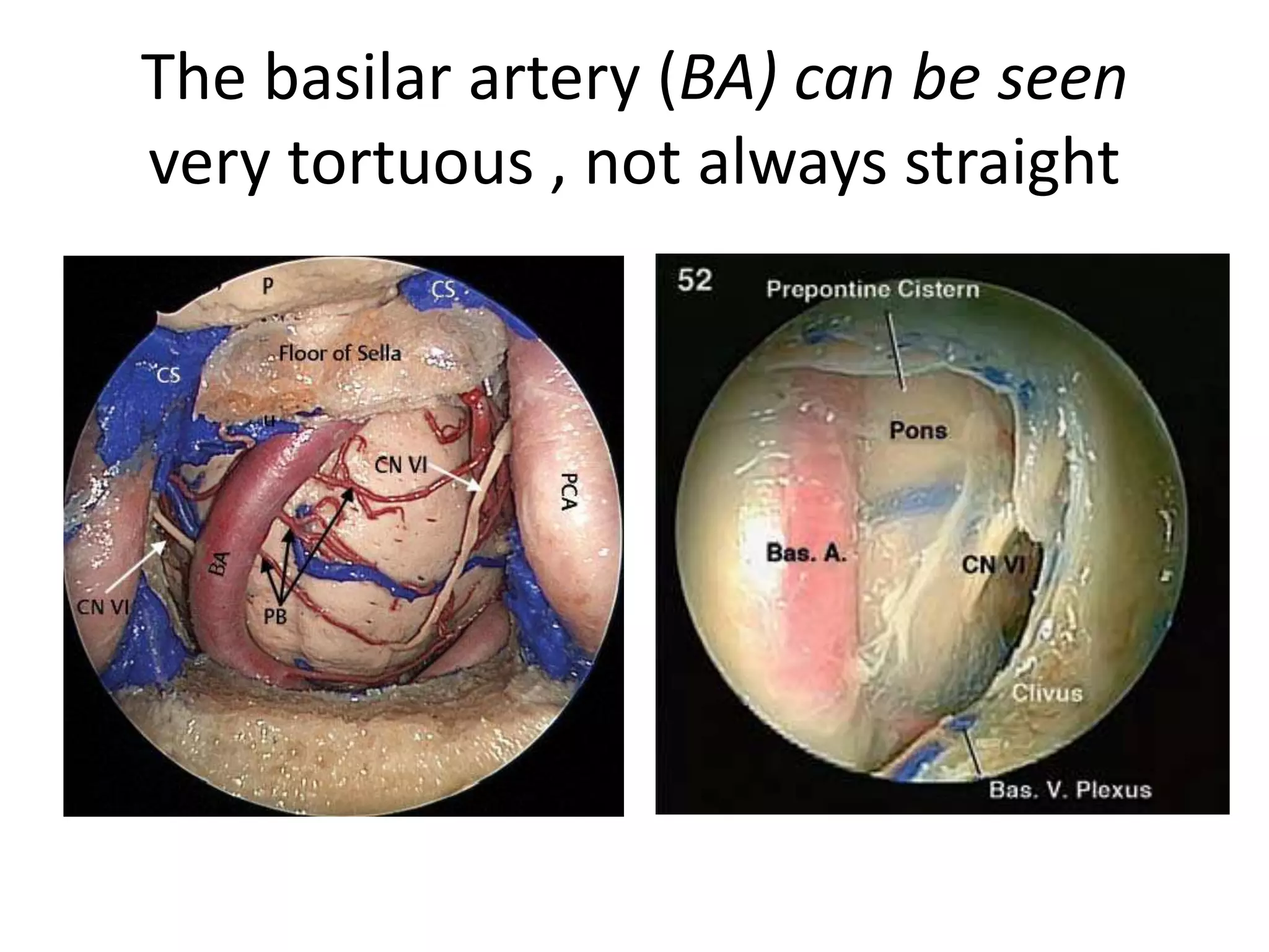 The basilar artery (BA) can be seen
very tortuous , not always straight
 