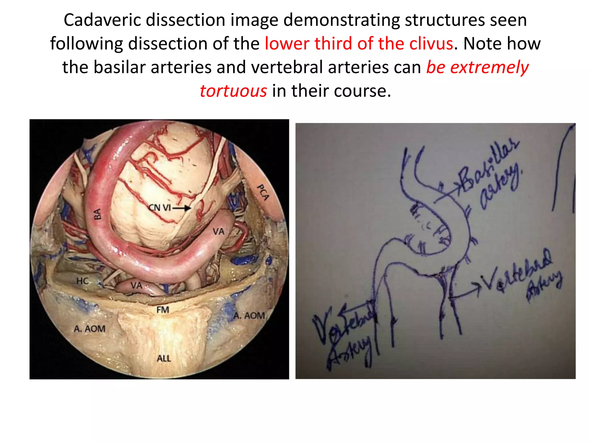 Cadaveric dissection image demonstrating structures seen
following dissection of the lower third of the clivus. Note how
the basilar arteries and vertebral arteries can be extremely
tortuous in their course.
 