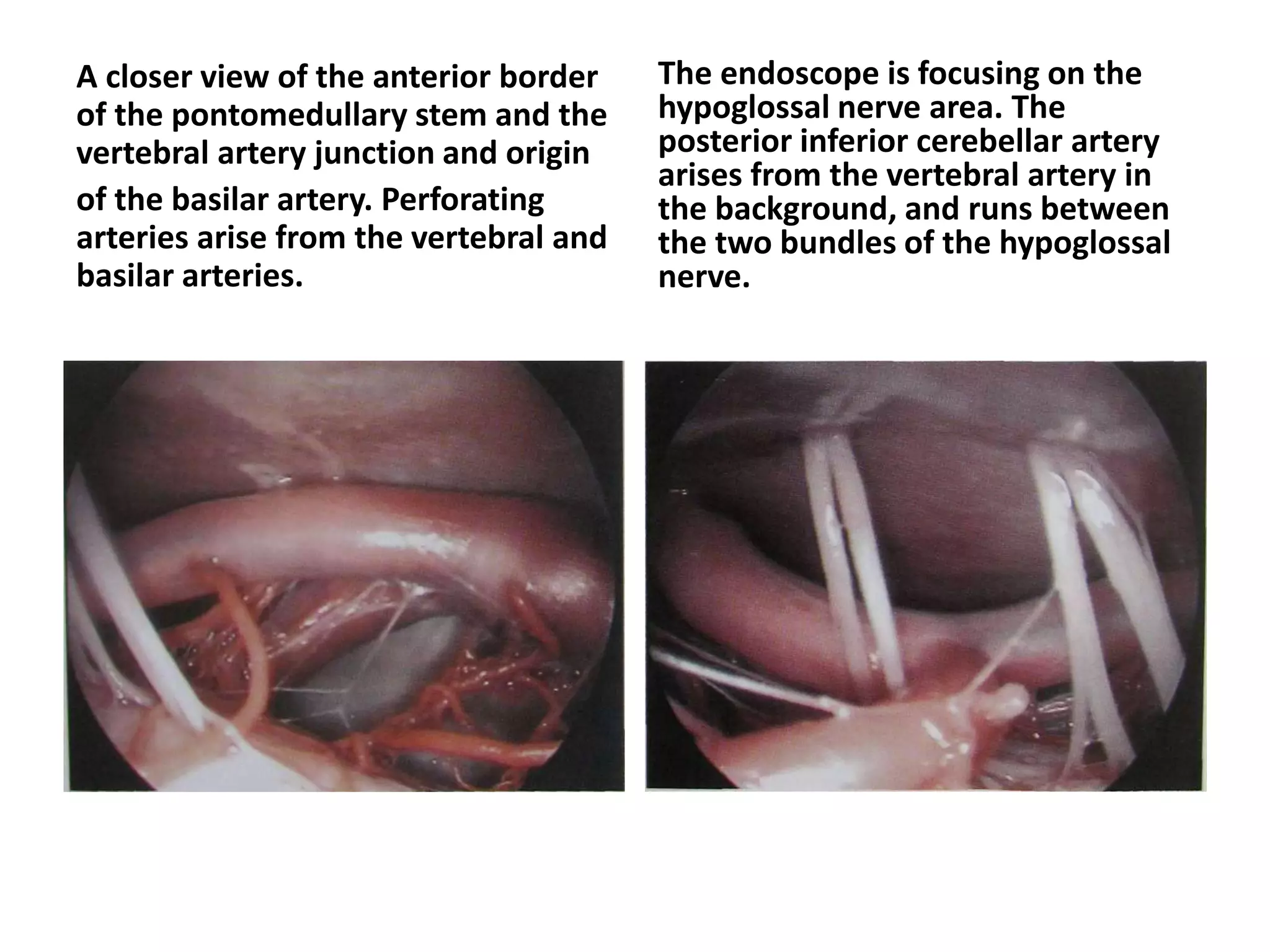 A closer view of the anterior border
of the pontomedullary stem and the
vertebral artery junction and origin
of the basilar artery. Perforating
arteries arise from the vertebral and
basilar arteries.
The endoscope is focusing on the
hypoglossal nerve area. The
posterior inferior cerebellar artery
arises from the vertebral artery in
the background, and runs between
the two bundles of the hypoglossal
nerve.
 
