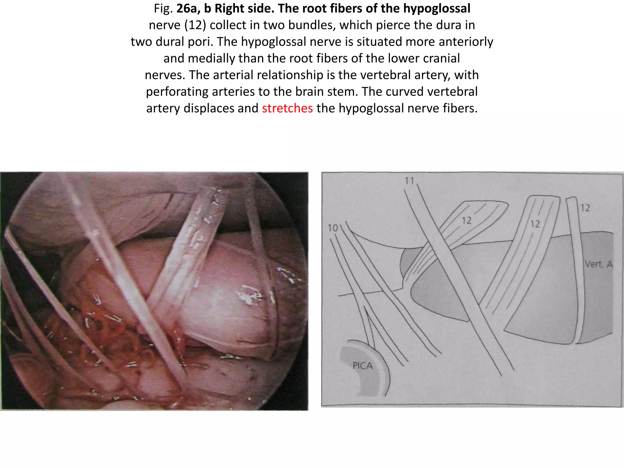 Fig. 26a, b Right side. The root fibers of the hypoglossal
nerve (12) collect in two bundles, which pierce the dura in
two dural pori. The hypoglossal nerve is situated more anteriorly
and medially than the root fibers of the lower cranial
nerves. The arterial relationship is the vertebral artery, with
perforating arteries to the brain stem. The curved vertebral
artery displaces and stretches the hypoglossal nerve fibers.
 