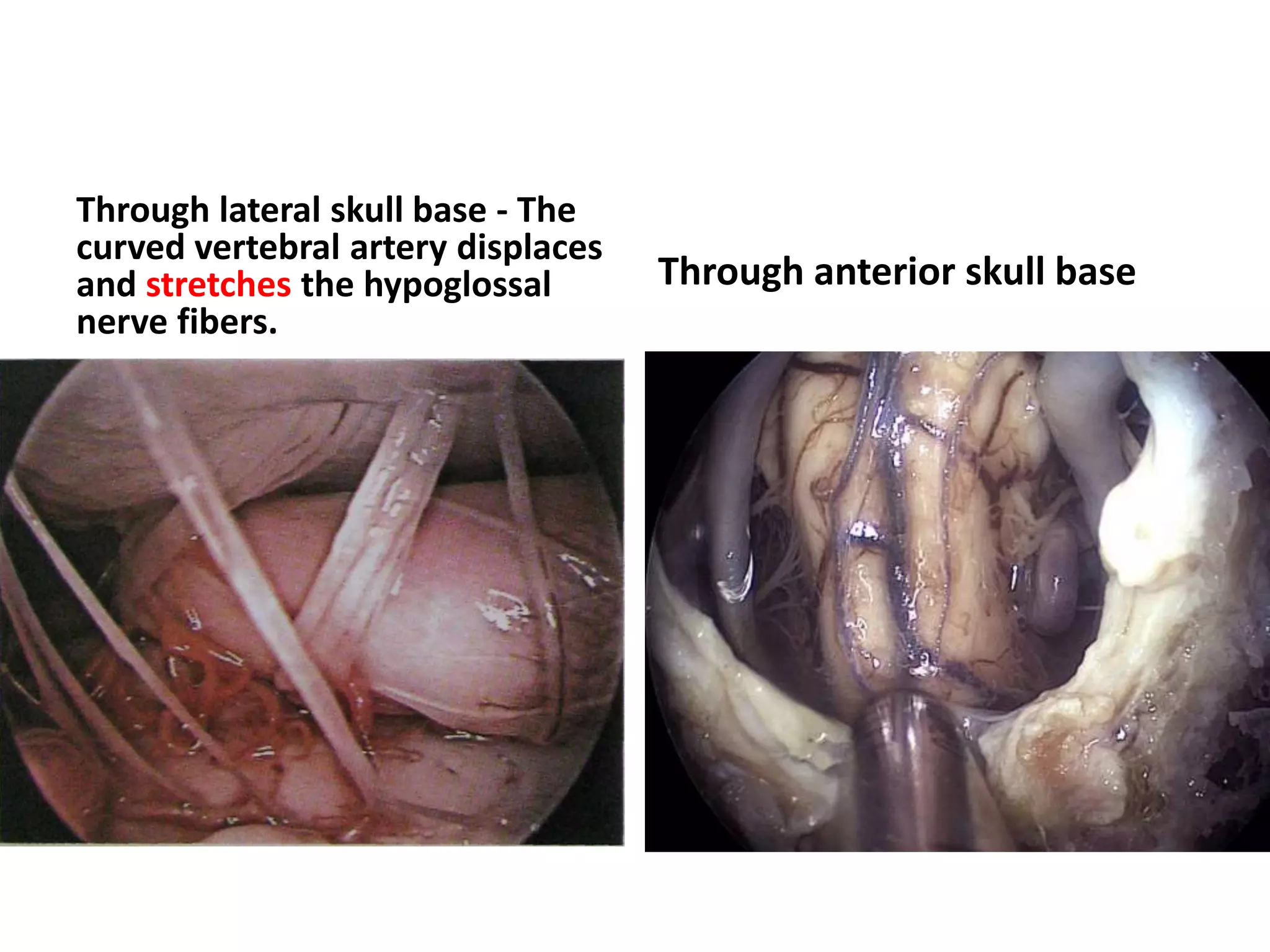 Through lateral skull base - The
curved vertebral artery displaces
and stretches the hypoglossal
nerve fibers.
Through anterior skull base
 
