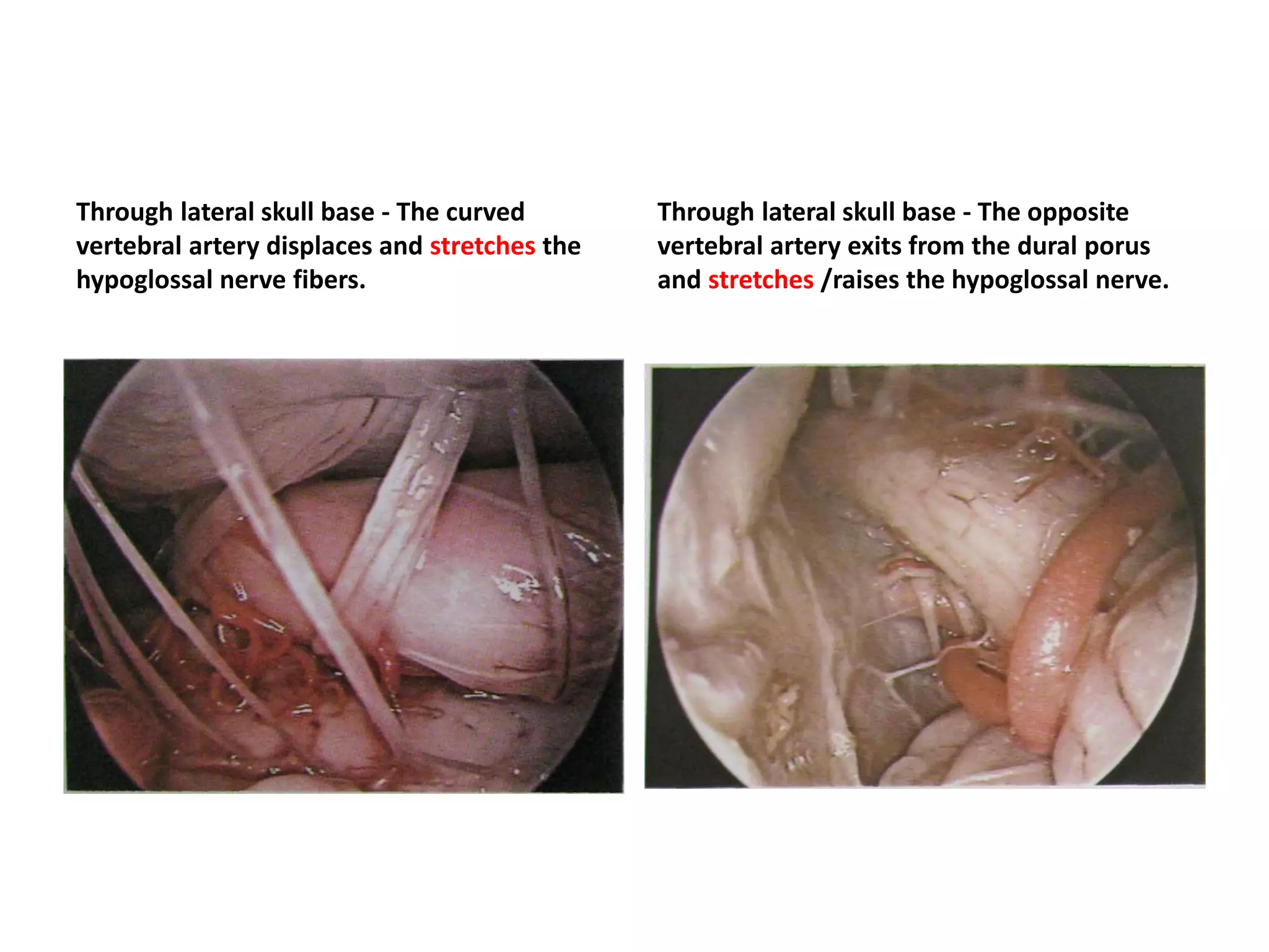 Through lateral skull base - The curved
vertebral artery displaces and stretches the
hypoglossal nerve fibers.
Through lateral skull base - The opposite
vertebral artery exits from the dural porus
and stretches /raises the hypoglossal nerve.
 
