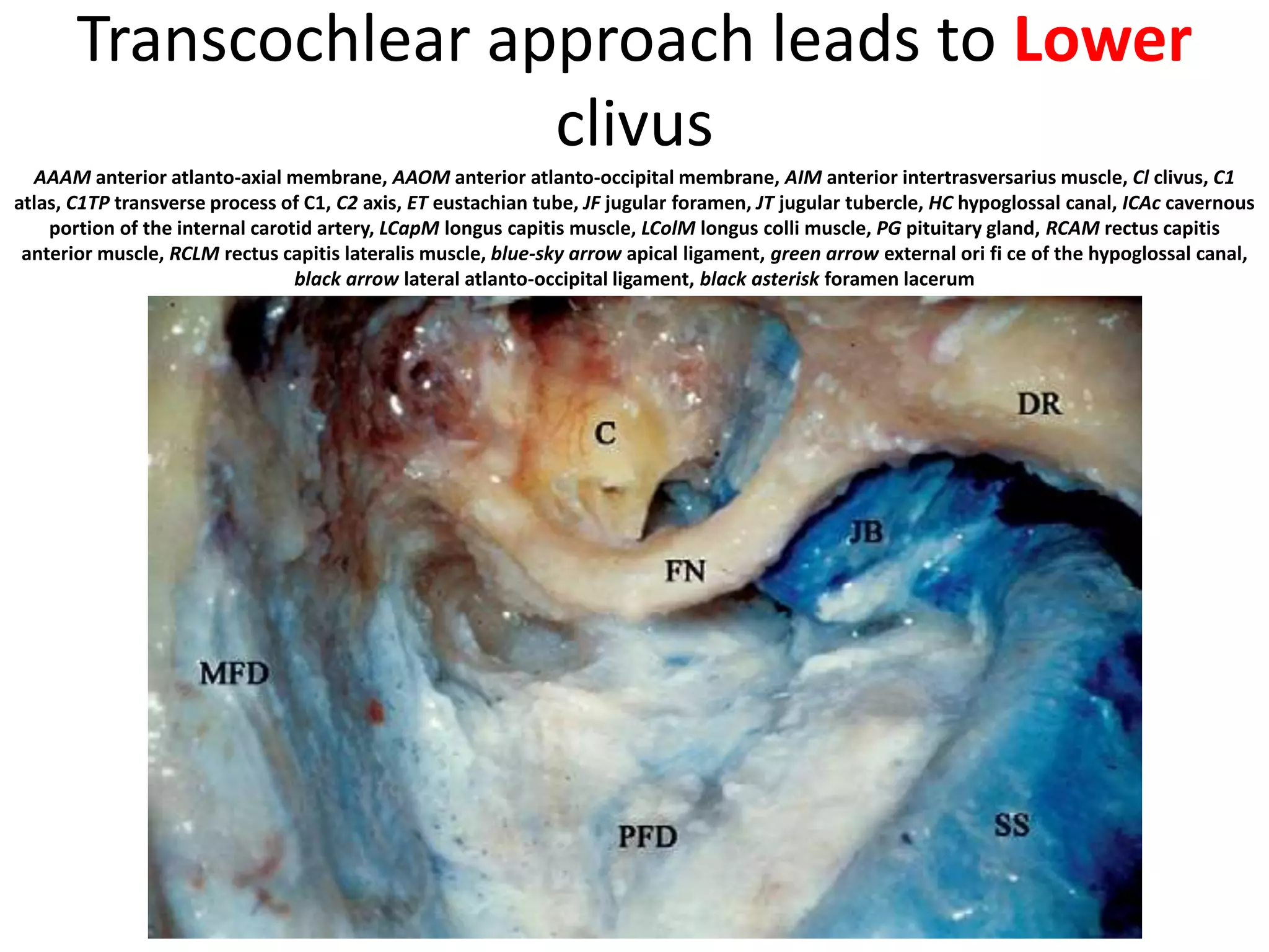 Transcochlear approach leads to Lower
clivus
AAAM anterior atlanto-axial membrane, AAOM anterior atlanto-occipital membrane, AIM anterior intertrasversarius muscle, Cl clivus, C1
atlas, C1TP transverse process of C1, C2 axis, ET eustachian tube, JF jugular foramen, JT jugular tubercle, HC hypoglossal canal, ICAc cavernous
portion of the internal carotid artery, LCapM longus capitis muscle, LColM longus colli muscle, PG pituitary gland, RCAM rectus capitis
anterior muscle, RCLM rectus capitis lateralis muscle, blue-sky arrow apical ligament, green arrow external ori fi ce of the hypoglossal canal,
black arrow lateral atlanto-occipital ligament, black asterisk foramen lacerum
 