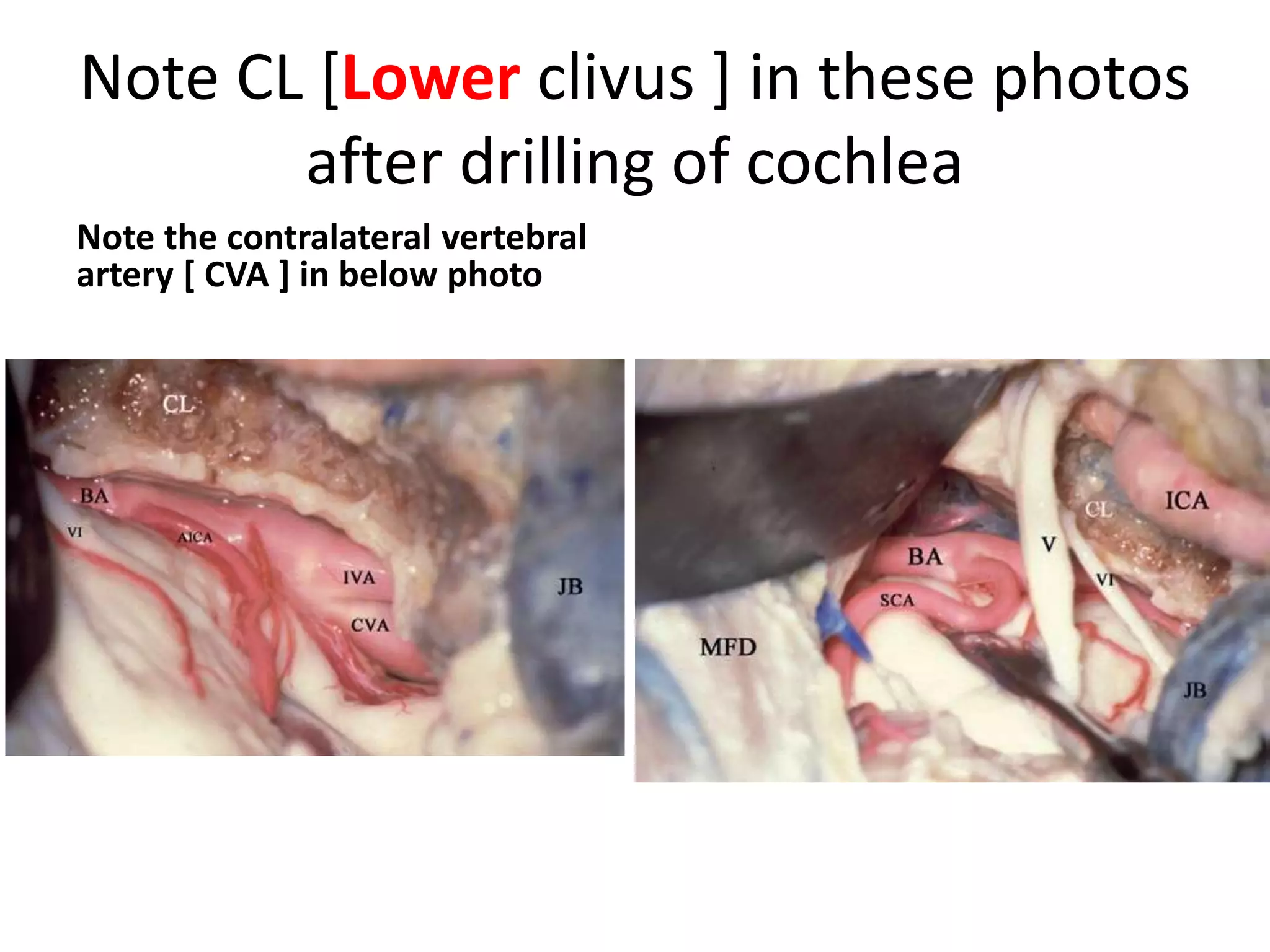 Note CL [Lower clivus ] in these photos
after drilling of cochlea
Note the contralateral vertebral
artery [ CVA ] in below photo
 