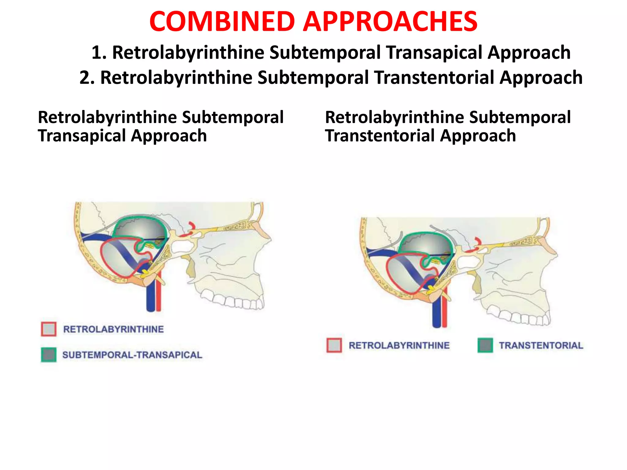 COMBINED APPROACHES
1. Retrolabyrinthine Subtemporal Transapical Approach
2. Retrolabyrinthine Subtemporal Transtentorial Approach
Retrolabyrinthine Subtemporal
Transapical Approach
Retrolabyrinthine Subtemporal
Transtentorial Approach
 