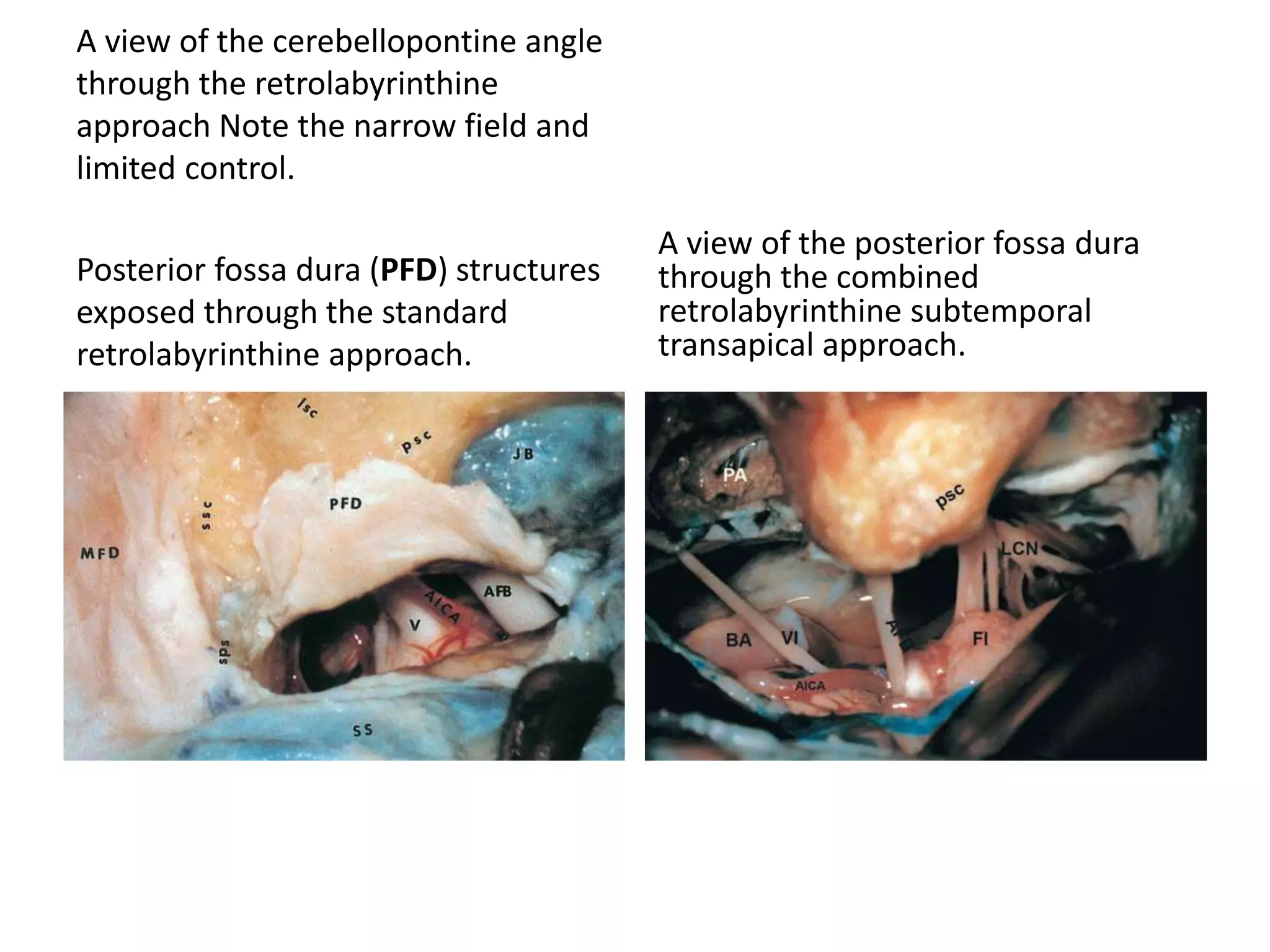 A view of the cerebellopontine angle
through the retrolabyrinthine
approach Note the narrow field and
limited control.
Posterior fossa dura (PFD) structures
exposed through the standard
retrolabyrinthine approach.
A view of the posterior fossa dura
through the combined
retrolabyrinthine subtemporal
transapical approach.
 