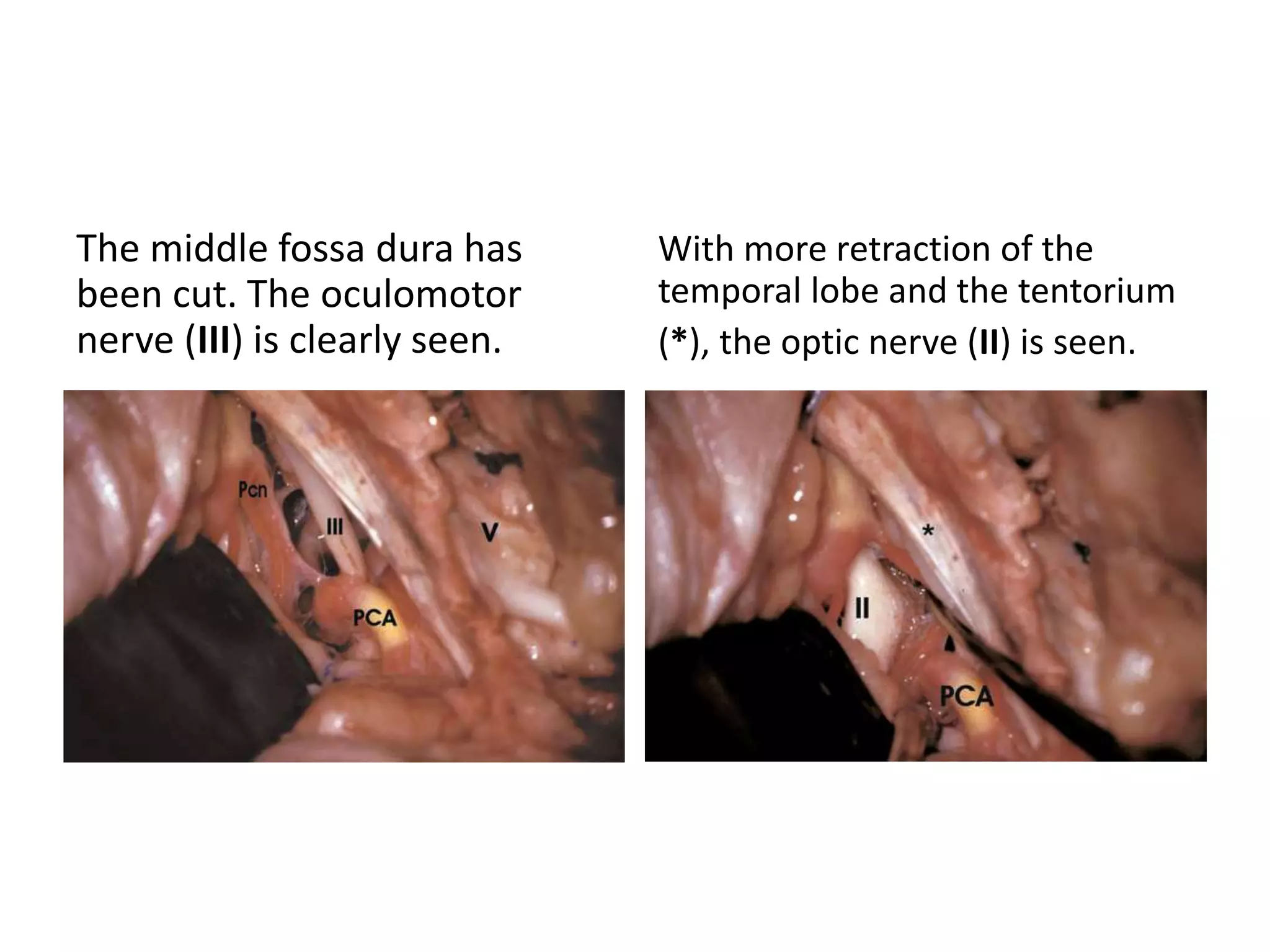 The middle fossa dura has
been cut. The oculomotor
nerve (III) is clearly seen.
With more retraction of the
temporal lobe and the tentorium
(*), the optic nerve (II) is seen.
 