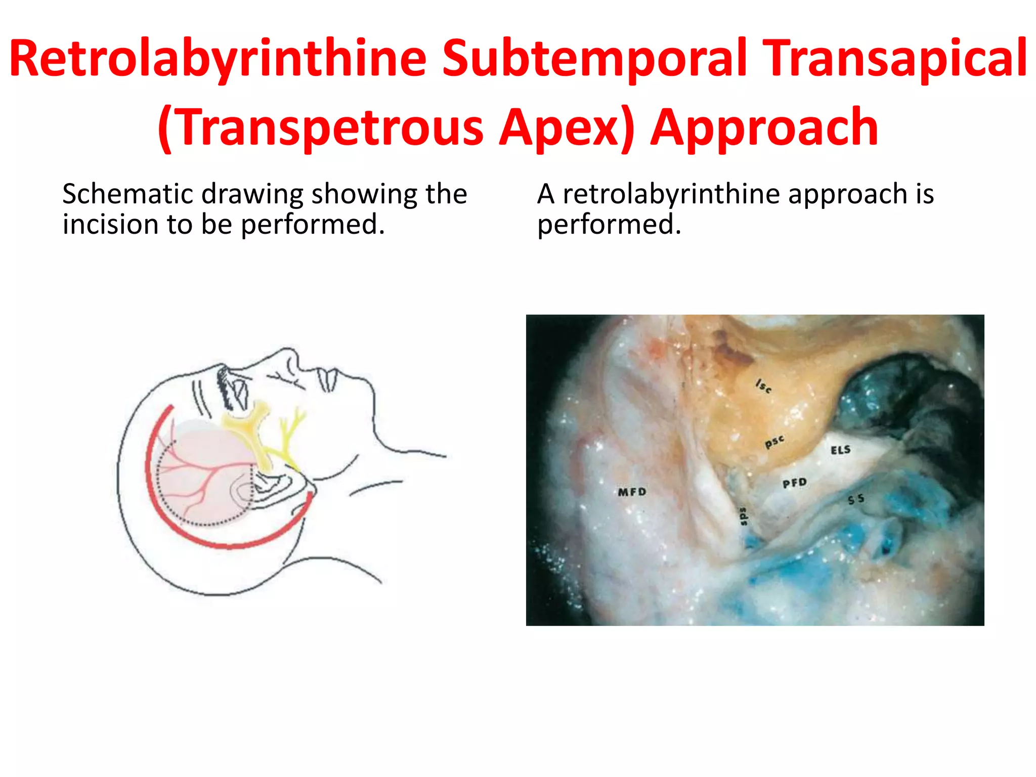 Retrolabyrinthine Subtemporal Transapical
(Transpetrous Apex) Approach
Schematic drawing showing the
incision to be performed.
A retrolabyrinthine approach is
performed.
 