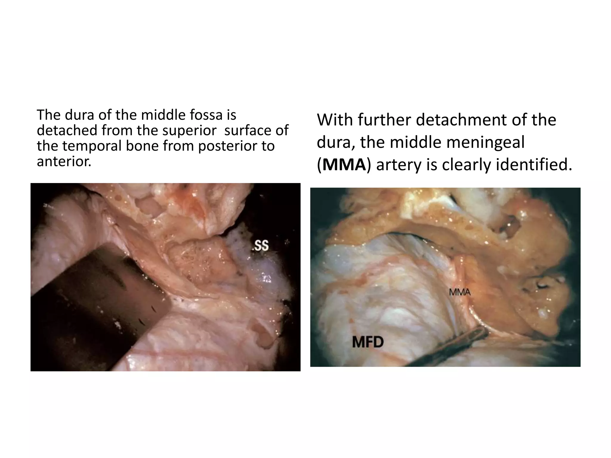 The dura of the middle fossa is
detached from the superior surface of
the temporal bone from posterior to
anterior.
With further detachment of the
dura, the middle meningeal
(MMA) artery is clearly identified.
 
