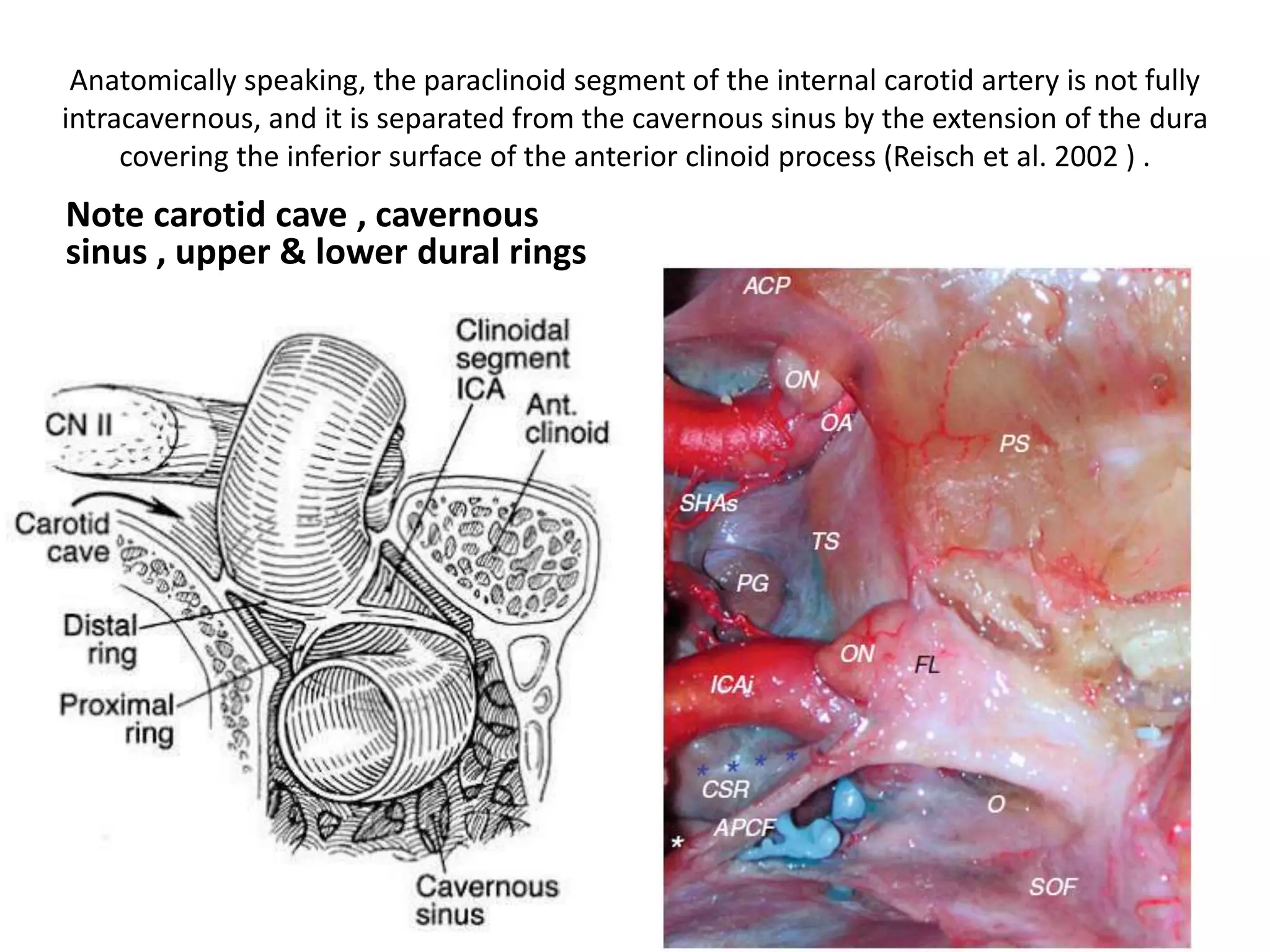 Anatomically speaking, the paraclinoid segment of the internal carotid artery is not fully
intracavernous, and it is separated from the cavernous sinus by the extension of the dura
covering the inferior surface of the anterior clinoid process (Reisch et al. 2002 ) .
Note carotid cave , cavernous
sinus , upper & lower dural rings
 