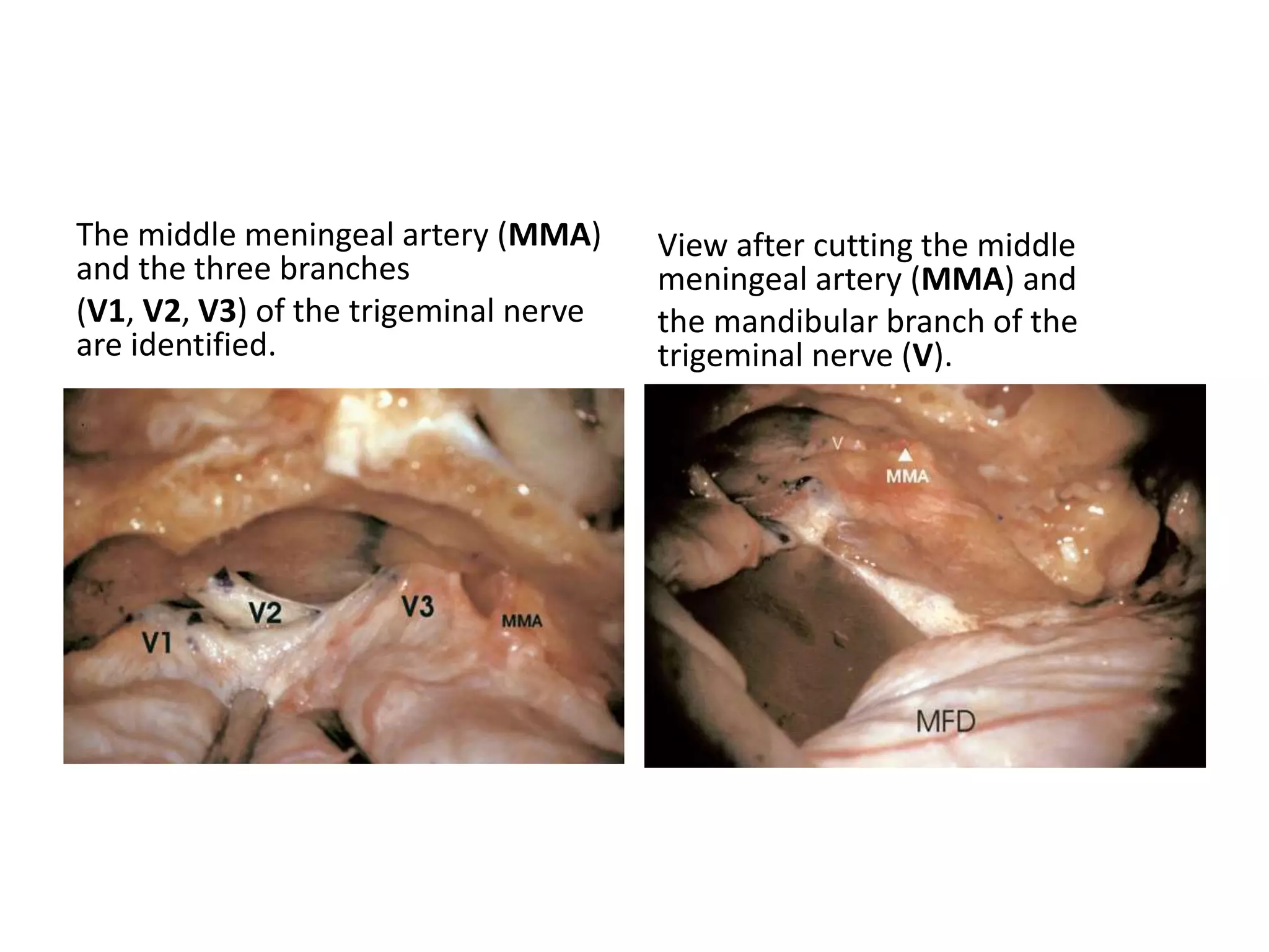The middle meningeal artery (MMA)
and the three branches
(V1, V2, V3) of the trigeminal nerve
are identified.
View after cutting the middle
meningeal artery (MMA) and
the mandibular branch of the
trigeminal nerve (V).
 