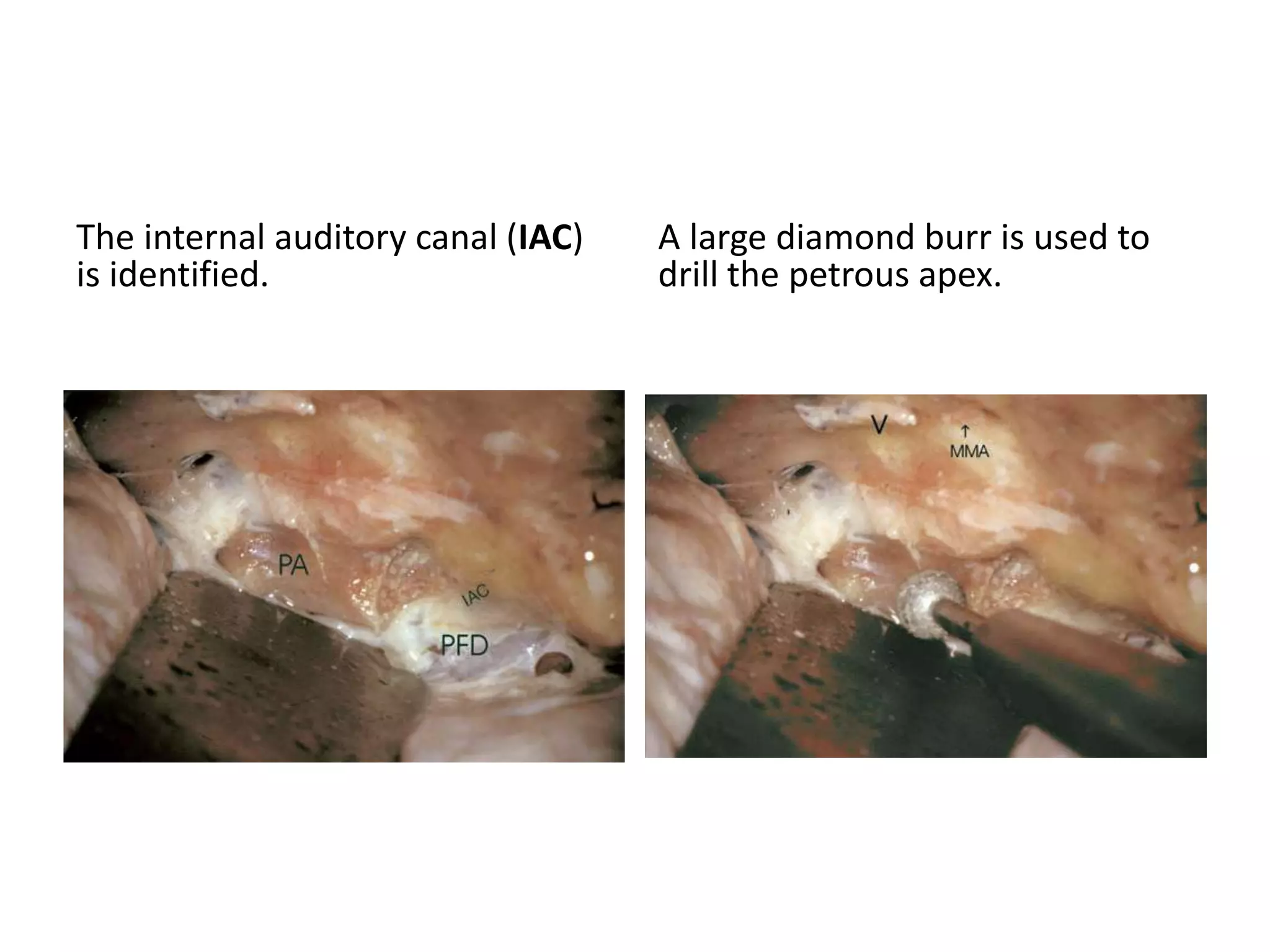 The internal auditory canal (IAC)
is identified.
A large diamond burr is used to
drill the petrous apex.
 