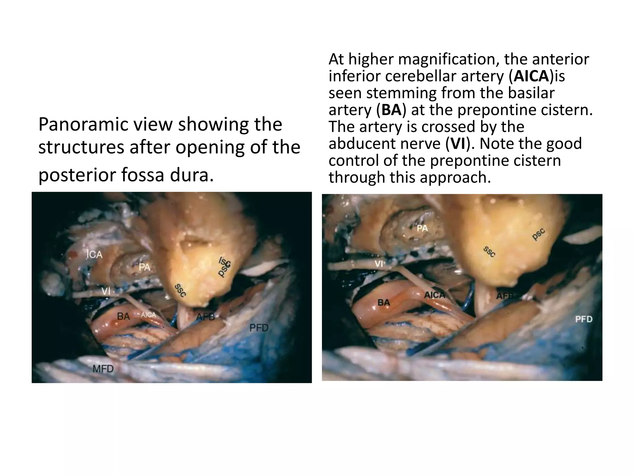 Panoramic view showing the
structures after opening of the
posterior fossa dura.
At higher magnification, the anterior
inferior cerebellar artery (AICA)is
seen stemming from the basilar
artery (BA) at the prepontine cistern.
The artery is crossed by the
abducent nerve (VI). Note the good
control of the prepontine cistern
through this approach.
 