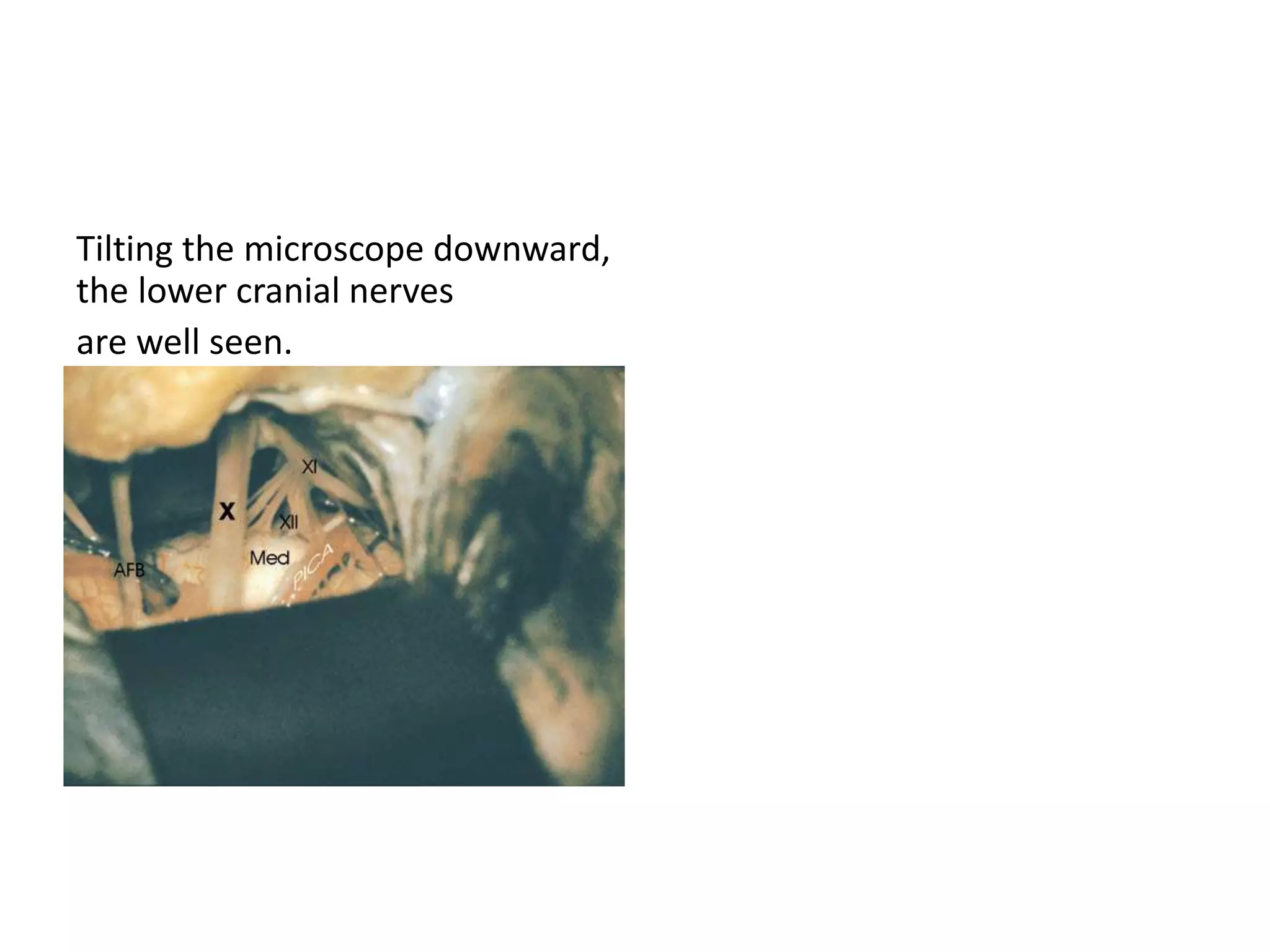 Tilting the microscope downward,
the lower cranial nerves
are well seen.
 