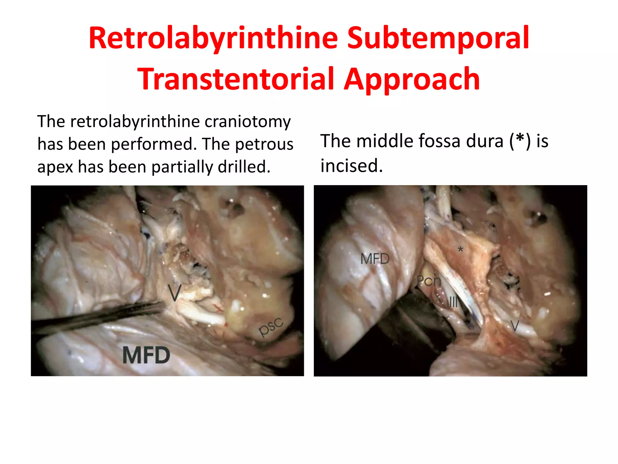 Retrolabyrinthine Subtemporal
Transtentorial Approach
The retrolabyrinthine craniotomy
has been performed. The petrous
apex has been partially drilled.
The middle fossa dura (*) is
incised.
 