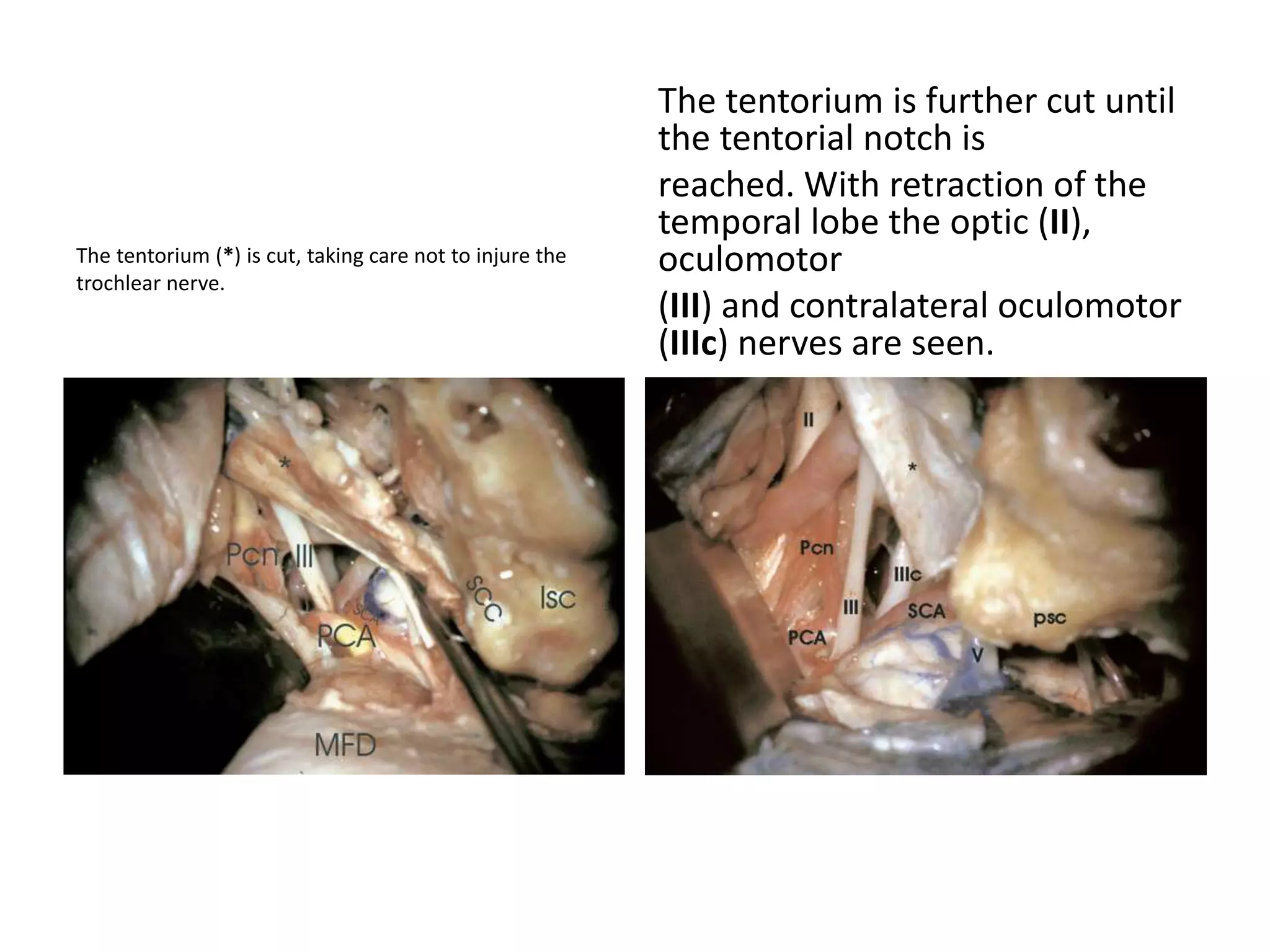 The tentorium (*) is cut, taking care not to injure the
trochlear nerve.
The tentorium is further cut until
the tentorial notch is
reached. With retraction of the
temporal lobe the optic (II),
oculomotor
(III) and contralateral oculomotor
(IIIc) nerves are seen.
 