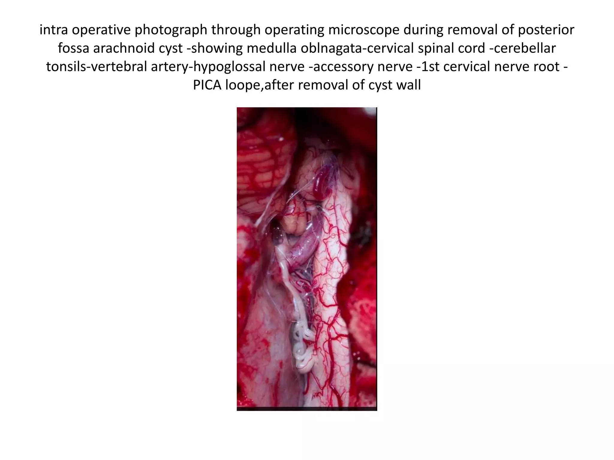 intra operative photograph through operating microscope during removal of posterior
fossa arachnoid cyst -showing medulla oblnagata-cervical spinal cord -cerebellar
tonsils-vertebral artery-hypoglossal nerve -accessory nerve -1st cervical nerve root -
PICA loope,after removal of cyst wall
 