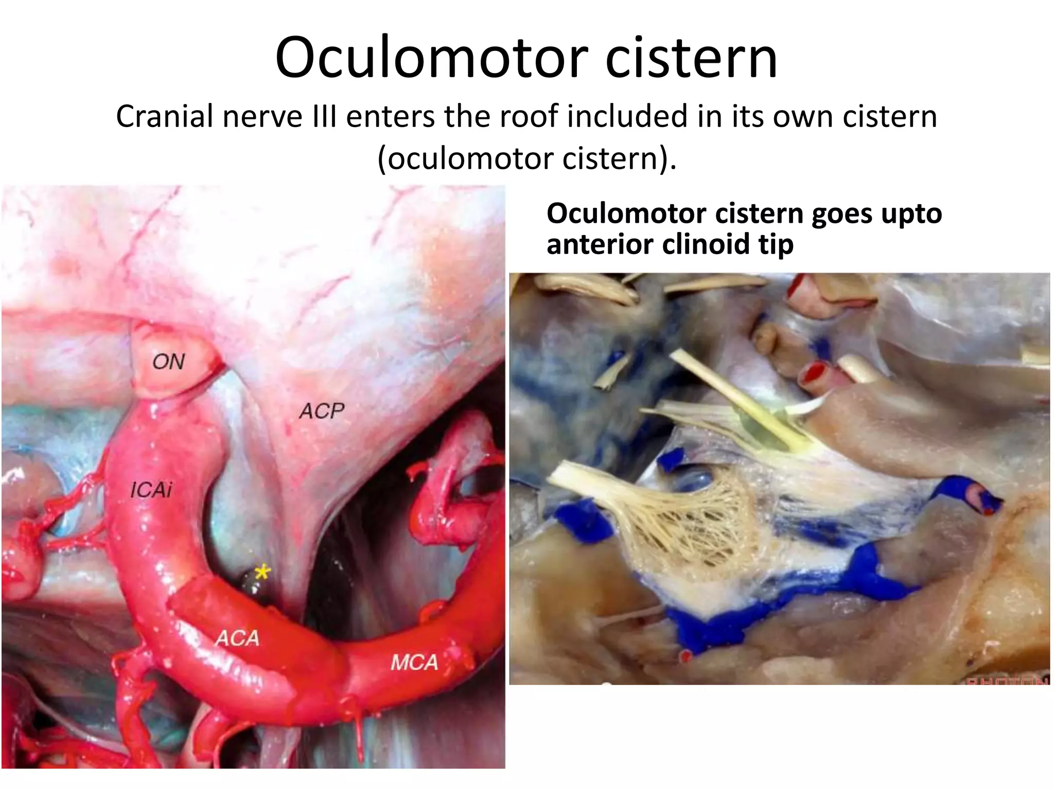 Oculomotor cistern
Cranial nerve III enters the roof included in its own cistern
(oculomotor cistern).
Oculomotor cistern goes upto
anterior clinoid tip
 