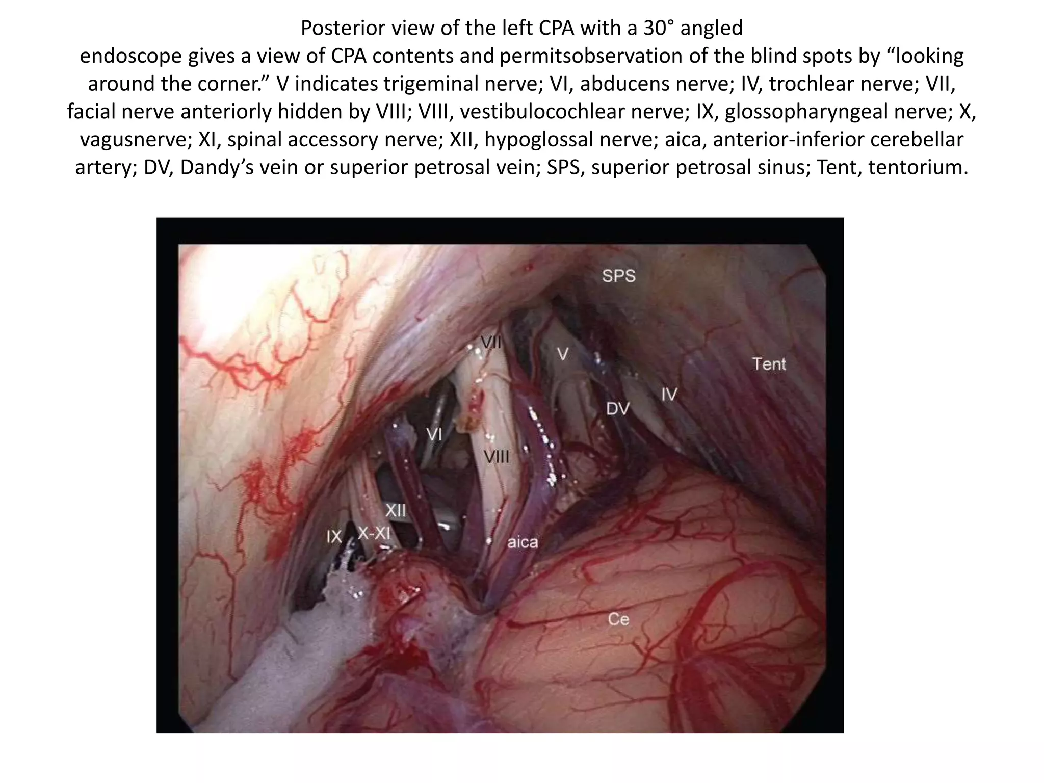 Posterior view of the left CPA with a 30° angled
endoscope gives a view of CPA contents and permitsobservation of the blind spots by “looking
around the corner.” V indicates trigeminal nerve; VI, abducens nerve; IV, trochlear nerve; VII,
facial nerve anteriorly hidden by VIII; VIII, vestibulocochlear nerve; IX, glossopharyngeal nerve; X,
vagusnerve; XI, spinal accessory nerve; XII, hypoglossal nerve; aica, anterior-inferior cerebellar
artery; DV, Dandy’s vein or superior petrosal vein; SPS, superior petrosal sinus; Tent, tentorium.
 