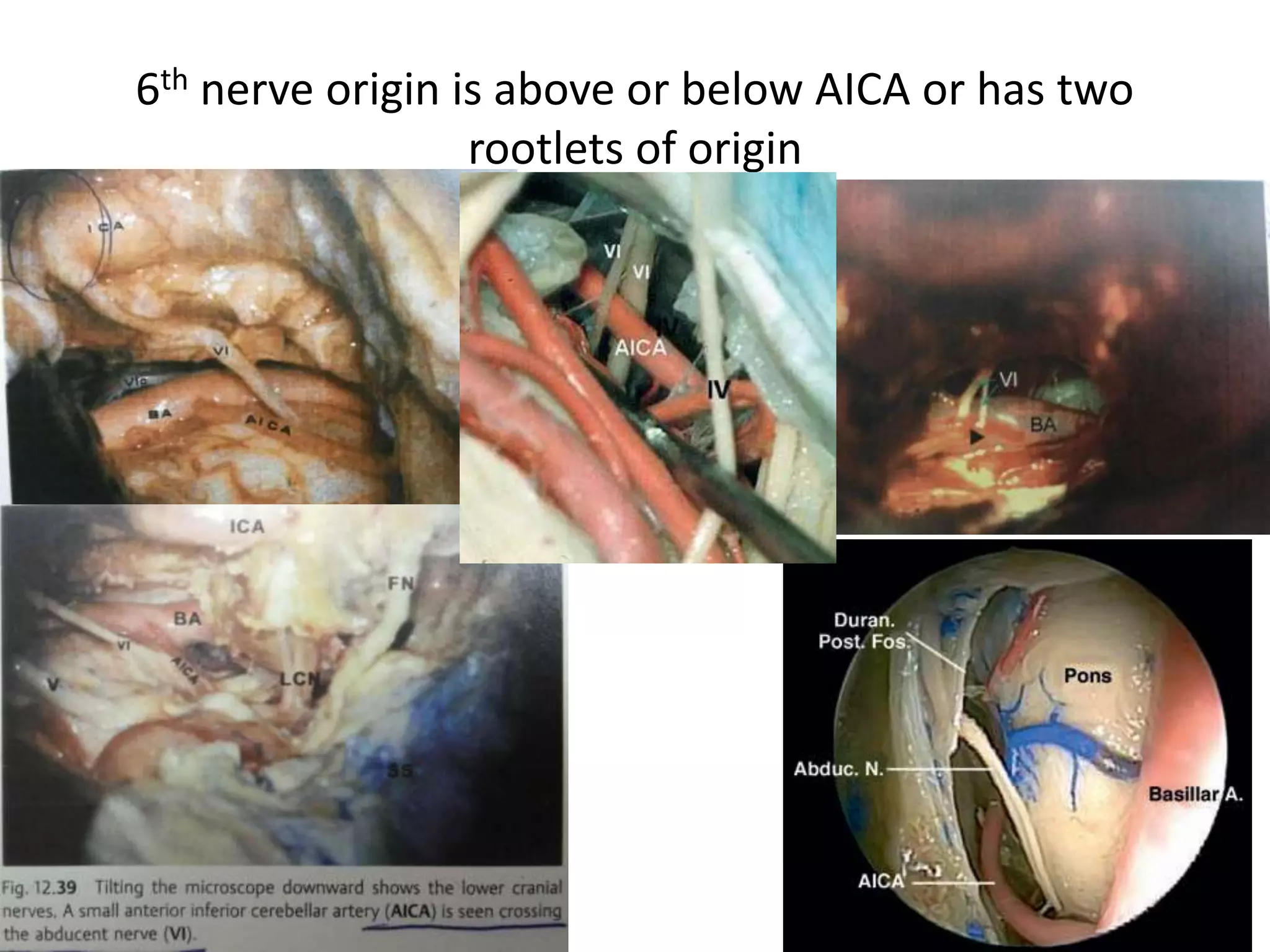 6th nerve origin is above or below AICA or has two
rootlets of origin
 