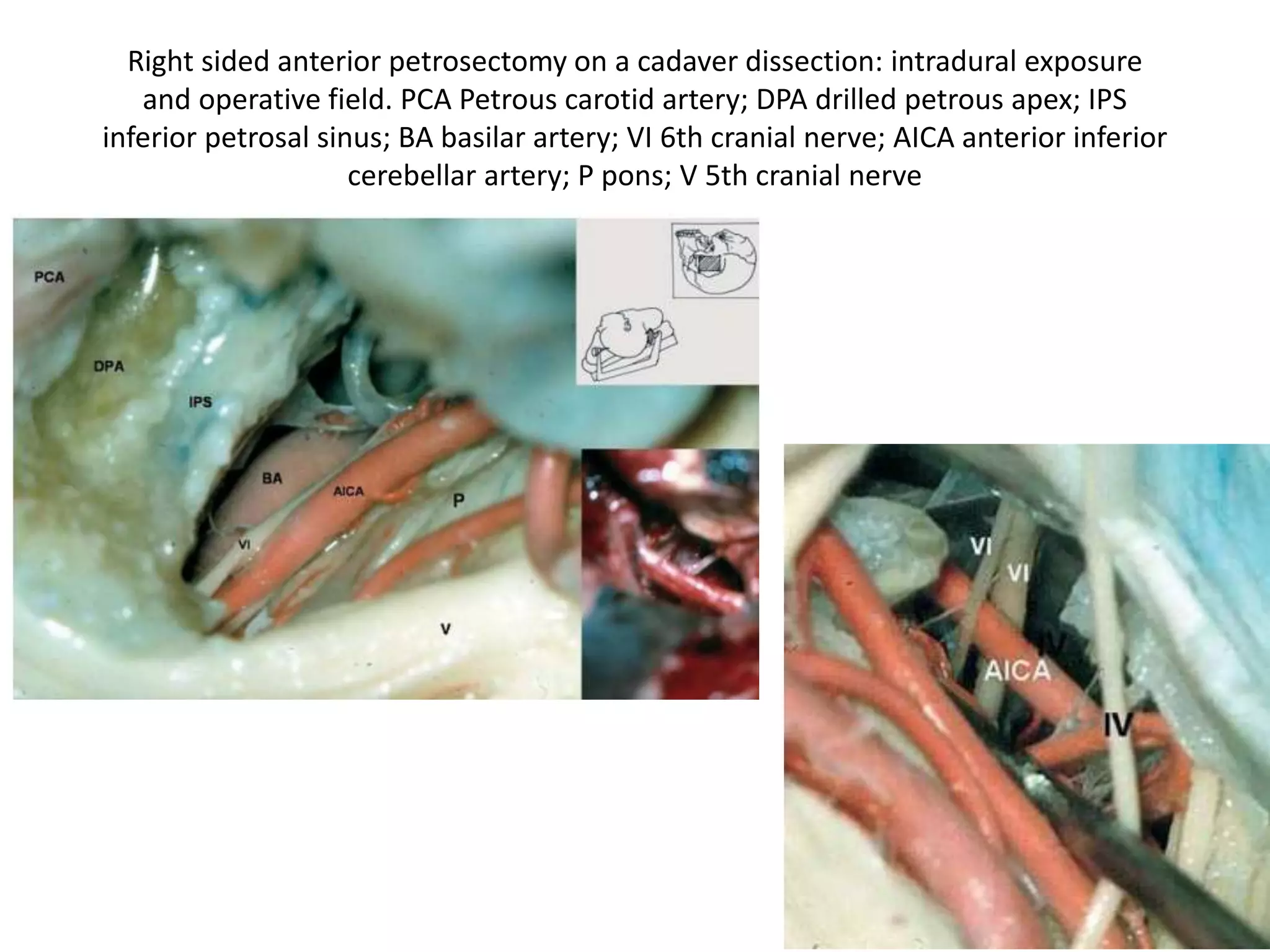 Right sided anterior petrosectomy on a cadaver dissection: intradural exposure
and operative field. PCA Petrous carotid artery; DPA drilled petrous apex; IPS
inferior petrosal sinus; BA basilar artery; VI 6th cranial nerve; AICA anterior inferior
cerebellar artery; P pons; V 5th cranial nerve
 