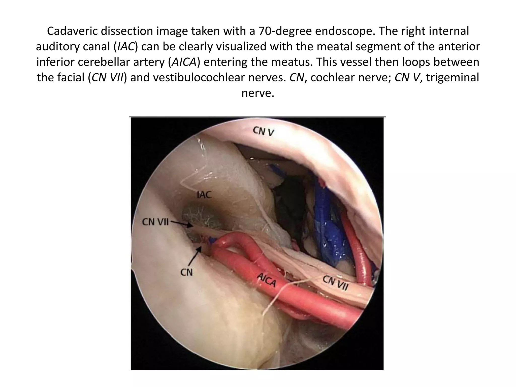 Cadaveric dissection image taken with a 70-degree endoscope. The right internal
auditory canal (IAC) can be clearly visualized with the meatal segment of the anterior
inferior cerebellar artery (AICA) entering the meatus. This vessel then loops between
the facial (CN VII) and vestibulocochlear nerves. CN, cochlear nerve; CN V, trigeminal
nerve.
 